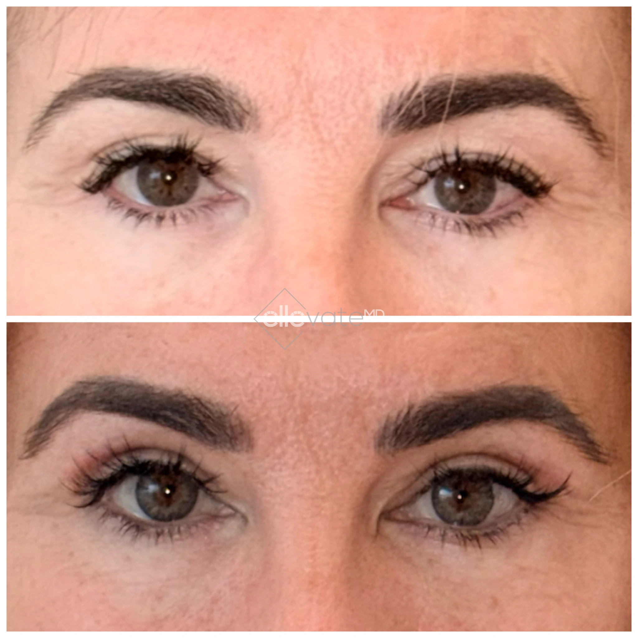 Signature Lift 242 before and after