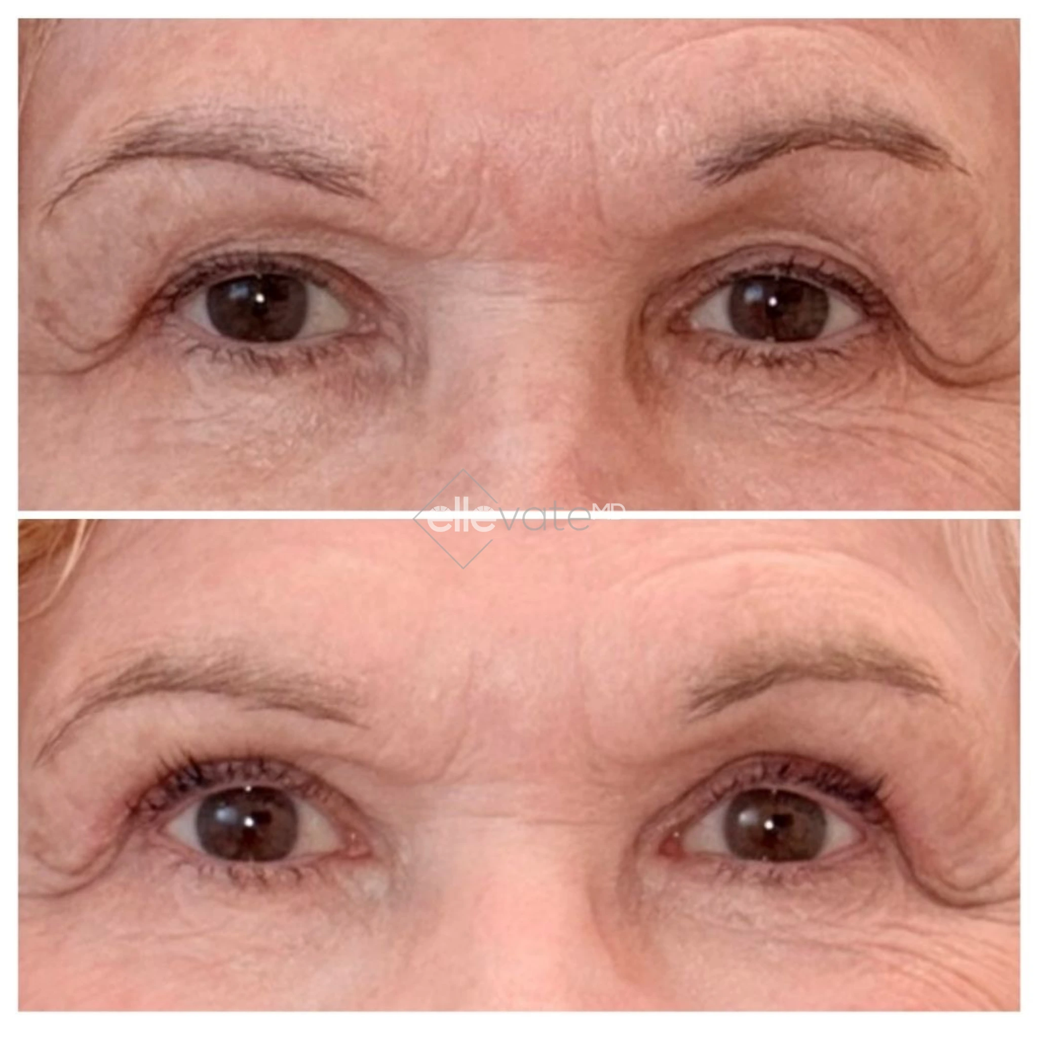 Signature Lift 243 before and after