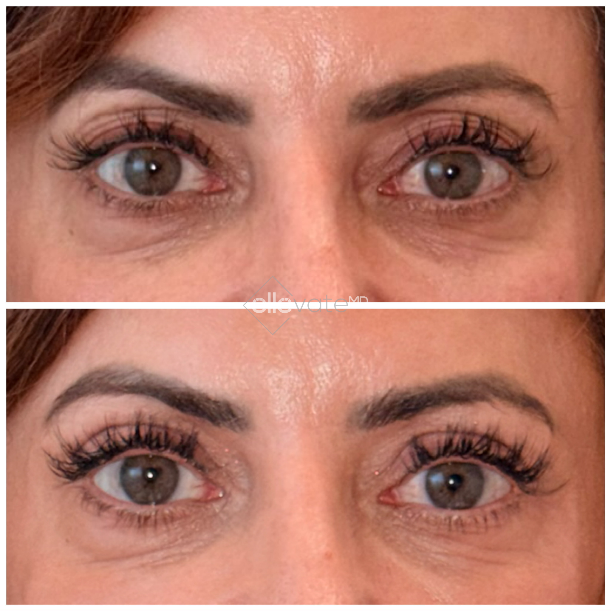 Signature Lift 244 before and after