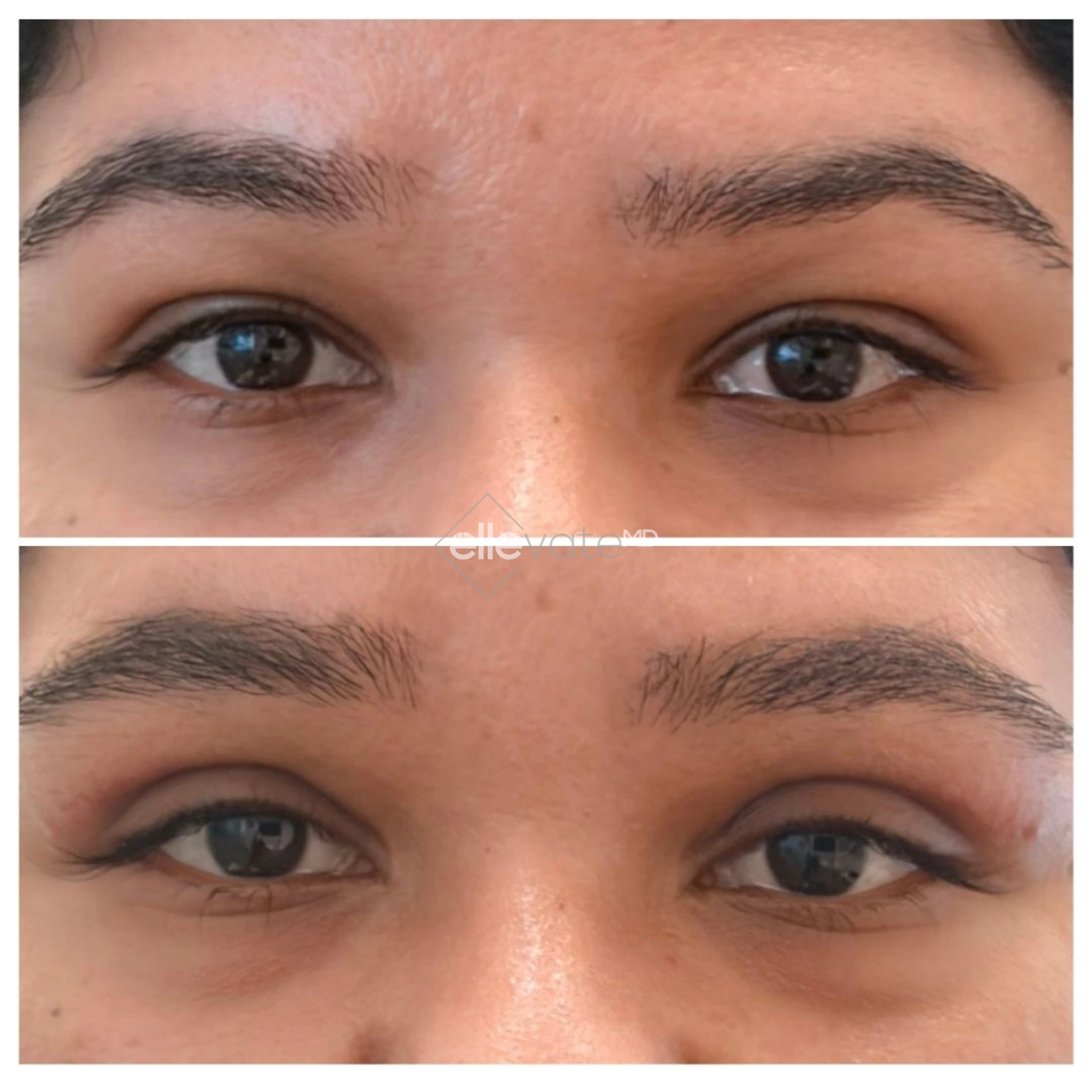 Signature Lift 245 before and after