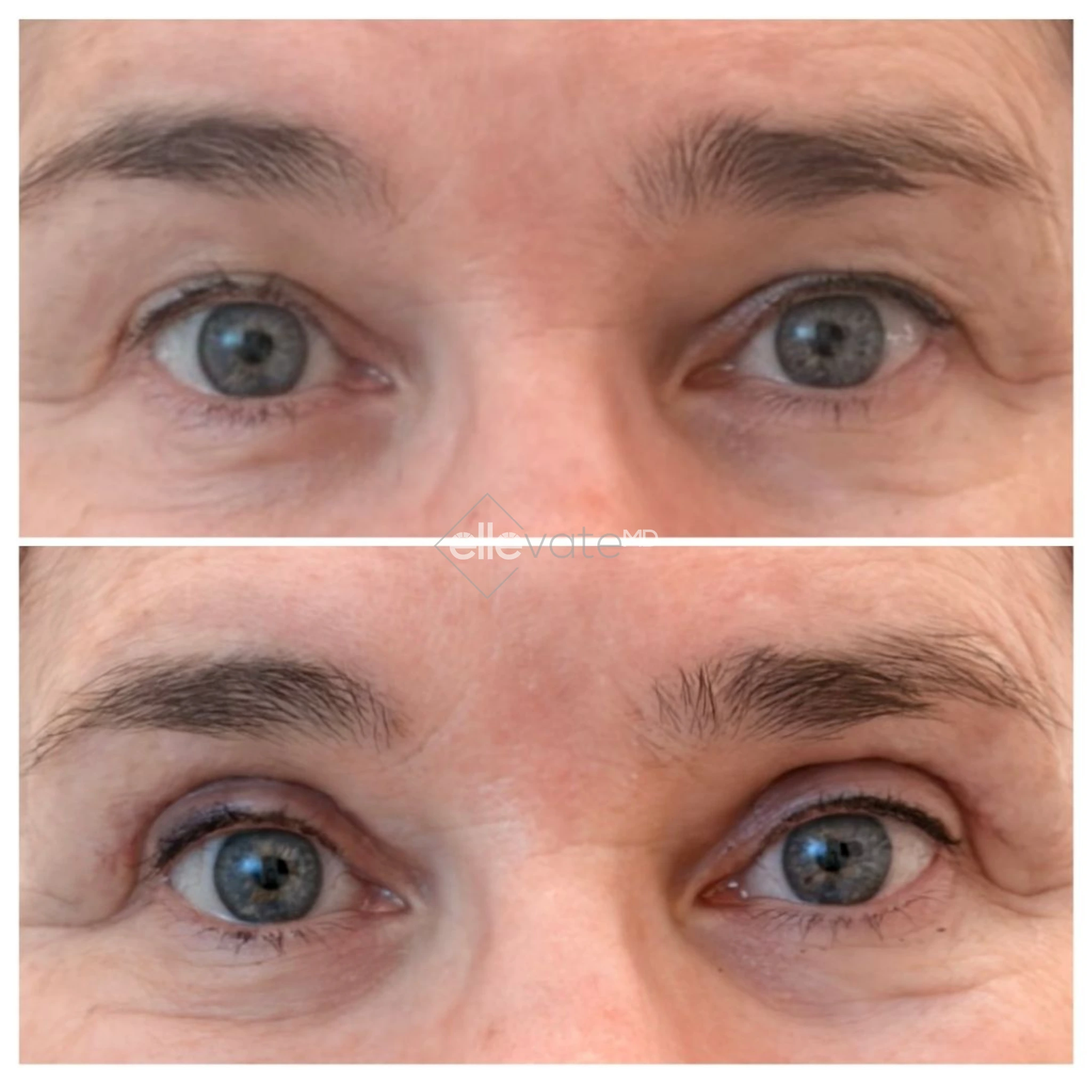 Signature Lift 246 before and after