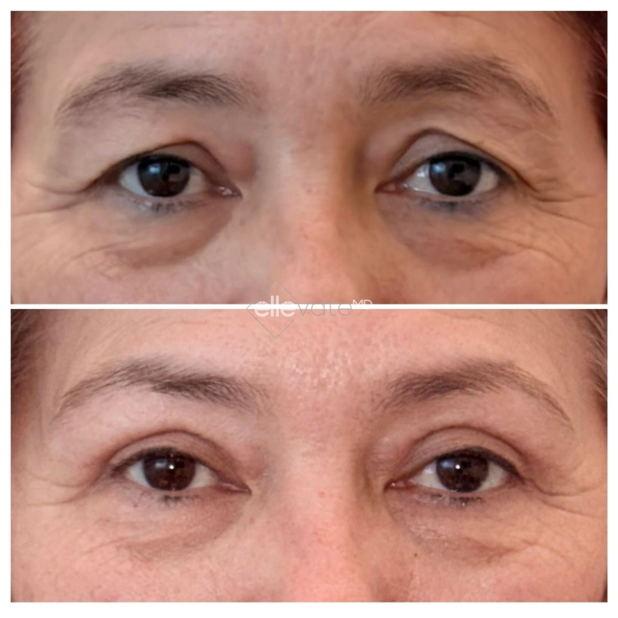 Signature Lift 247 before and after