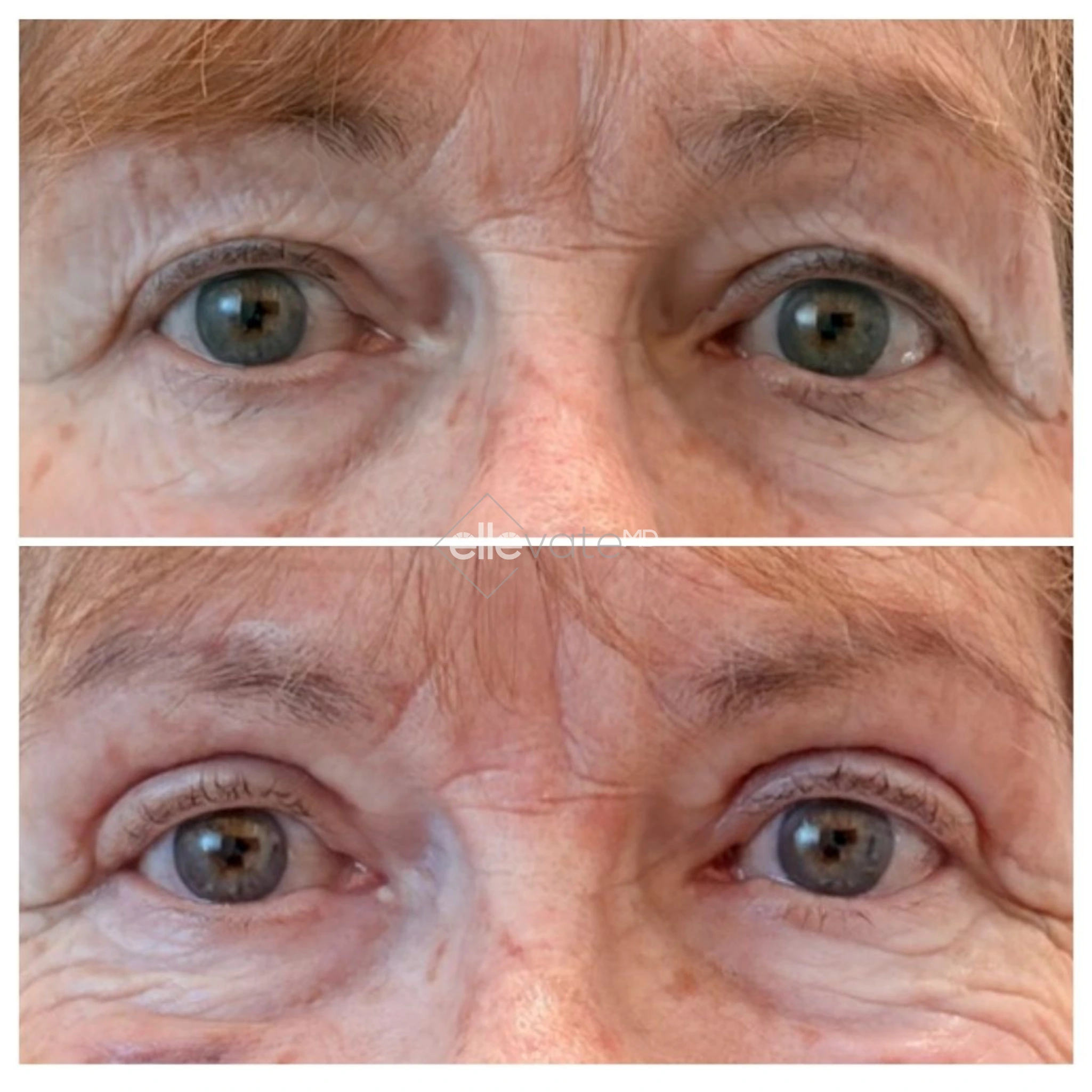 Signature Lift 248 before and after