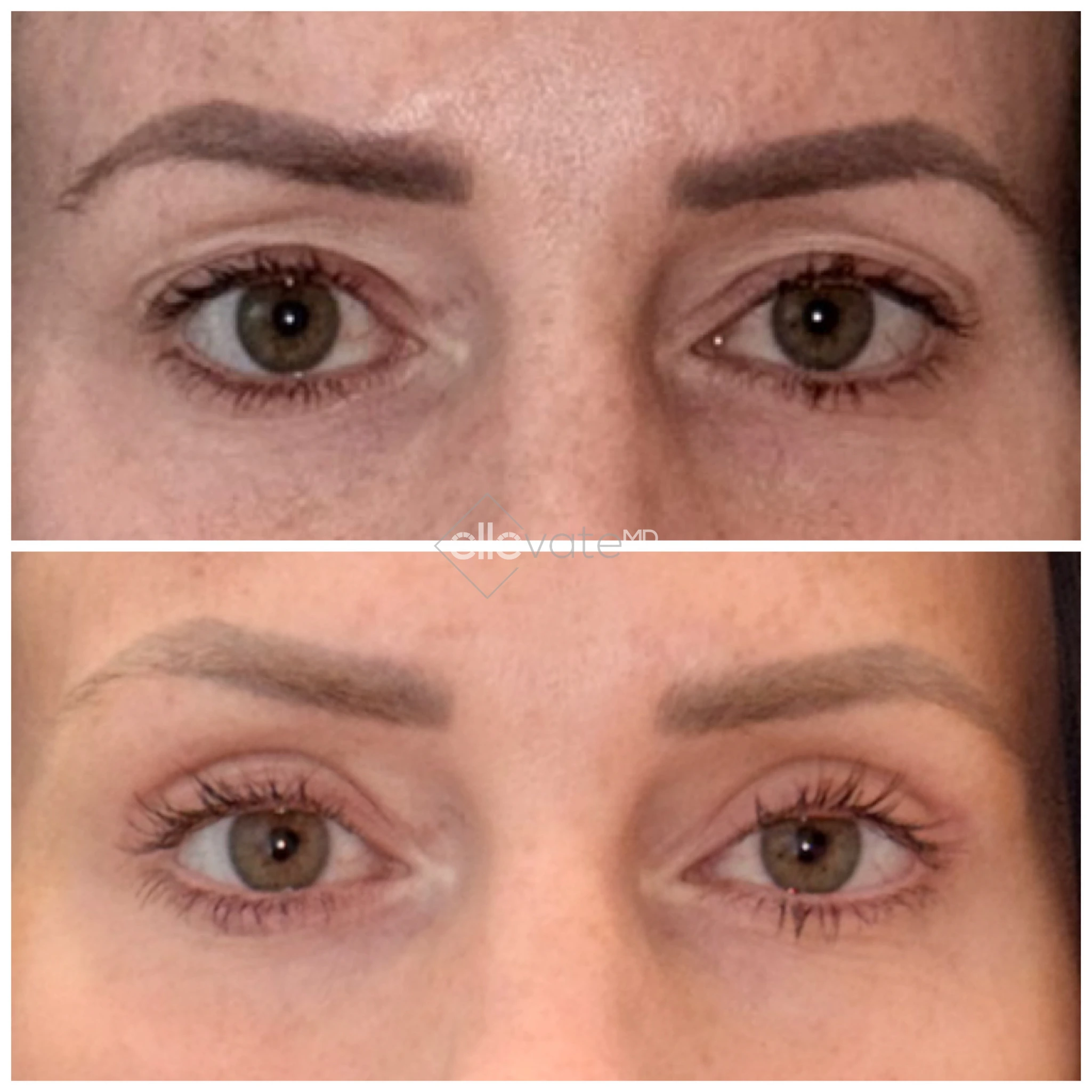 Signature Lift 249 before and after