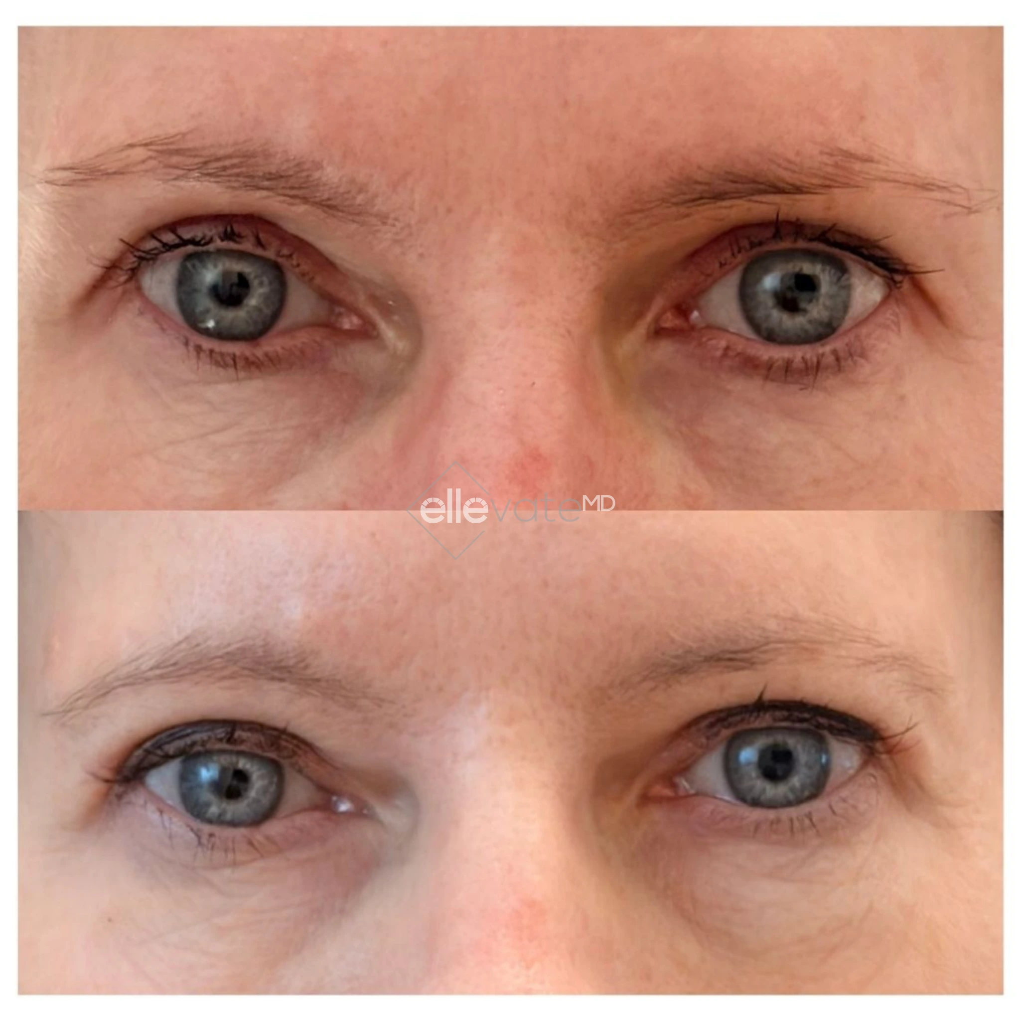 Signature Lift 250 before and after
