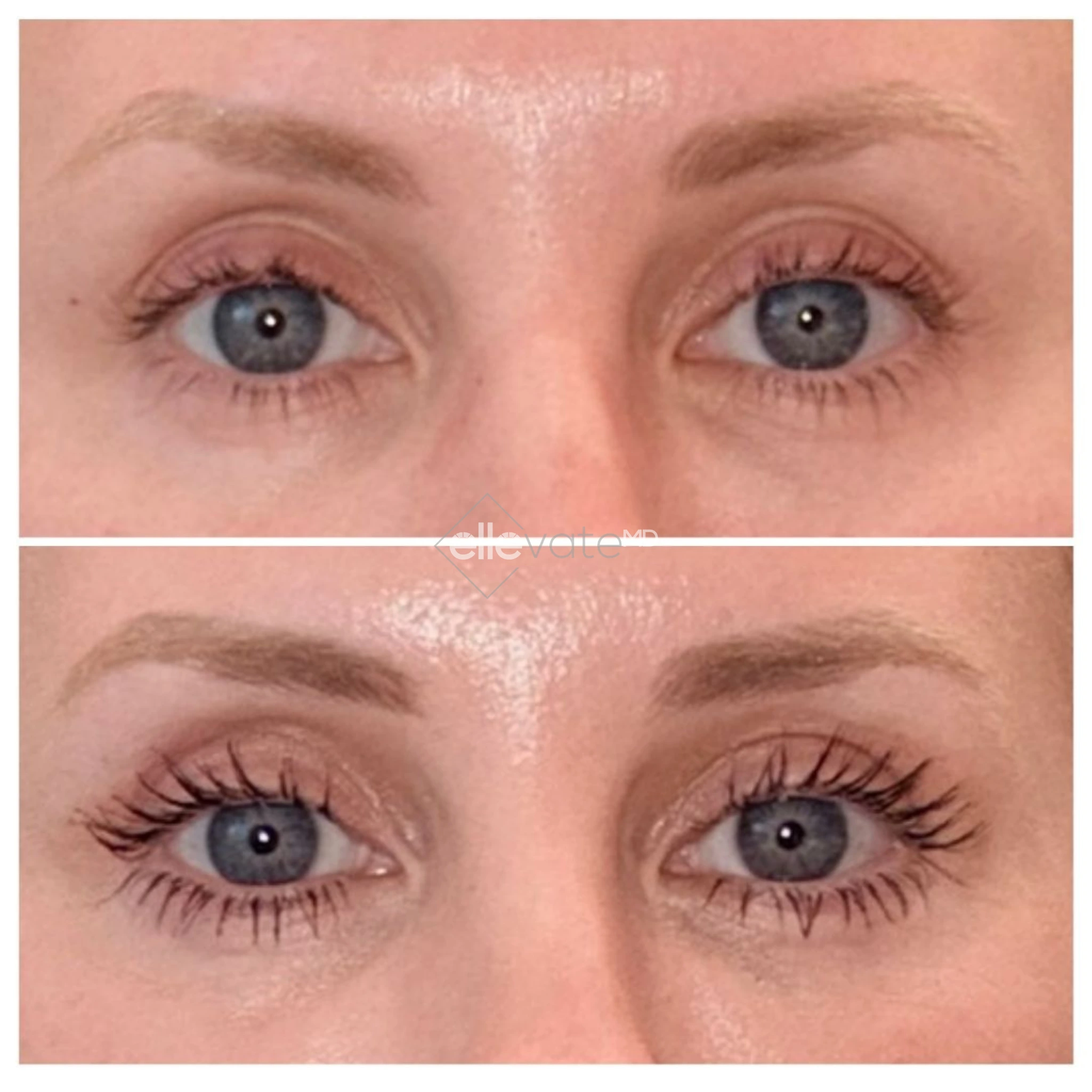 Signature Lift 251 before and after