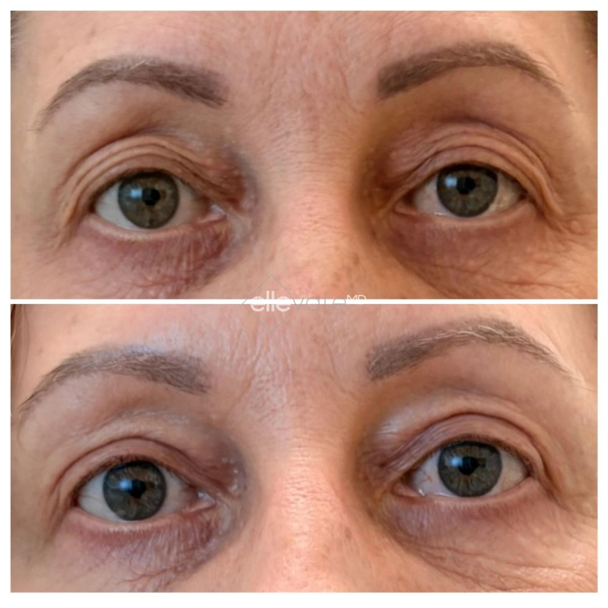 Signature Lift 252 before and after