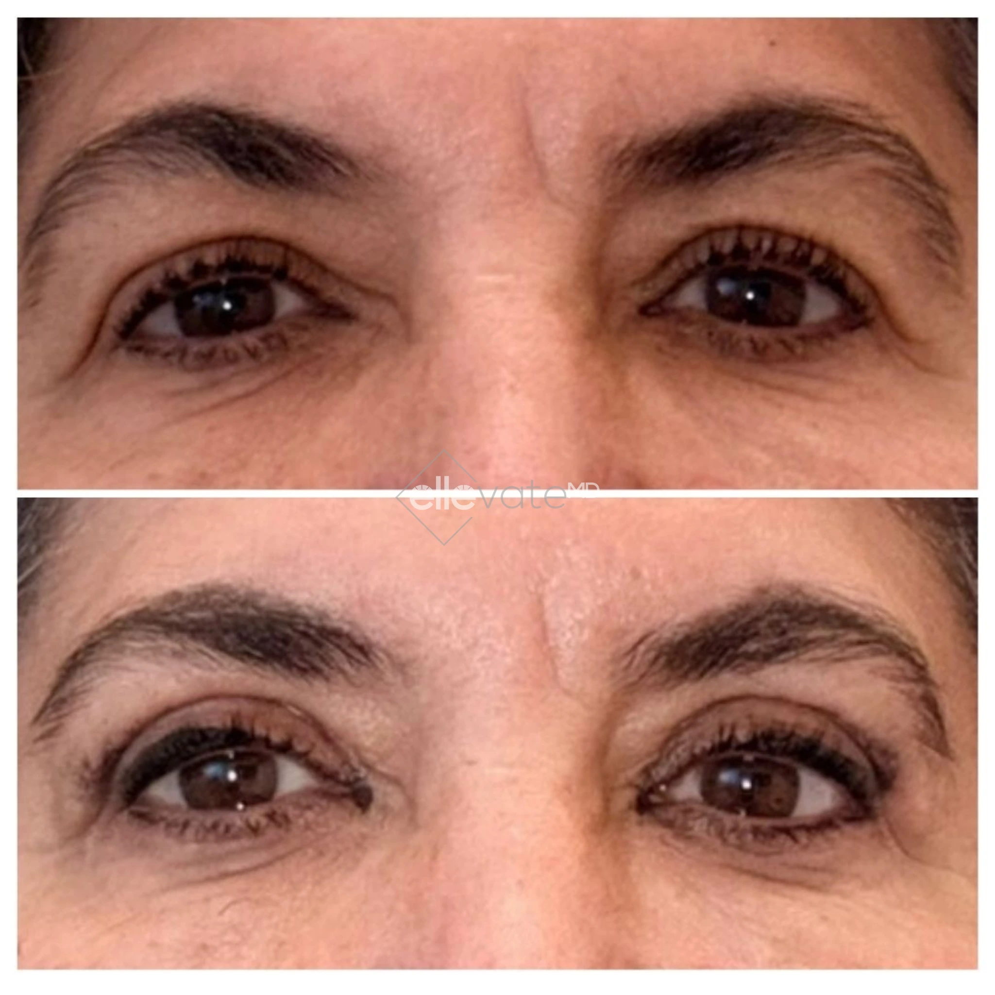 Signature Lift 253 before and after