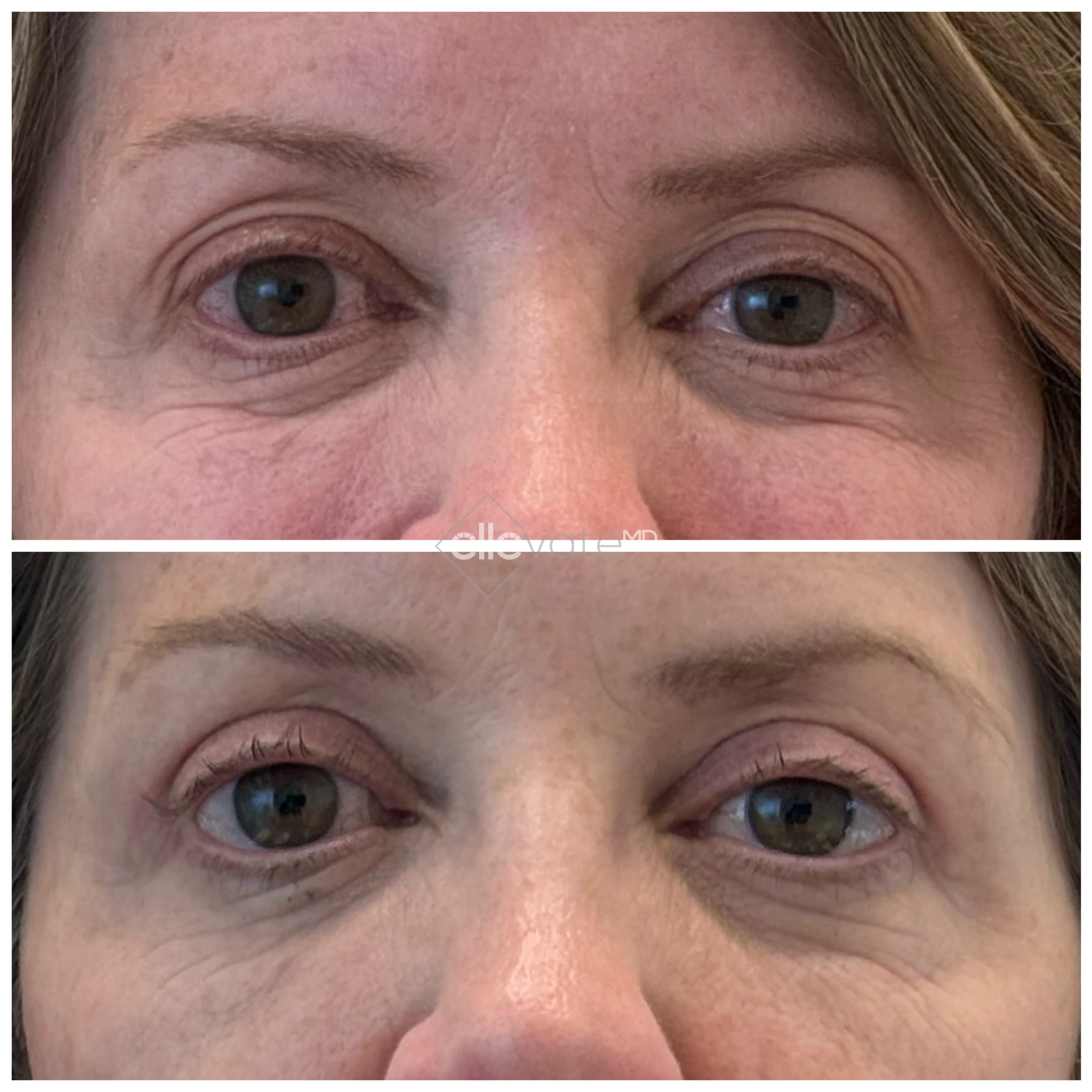 Upper Lid Lift for Asymmetry 1 before and after