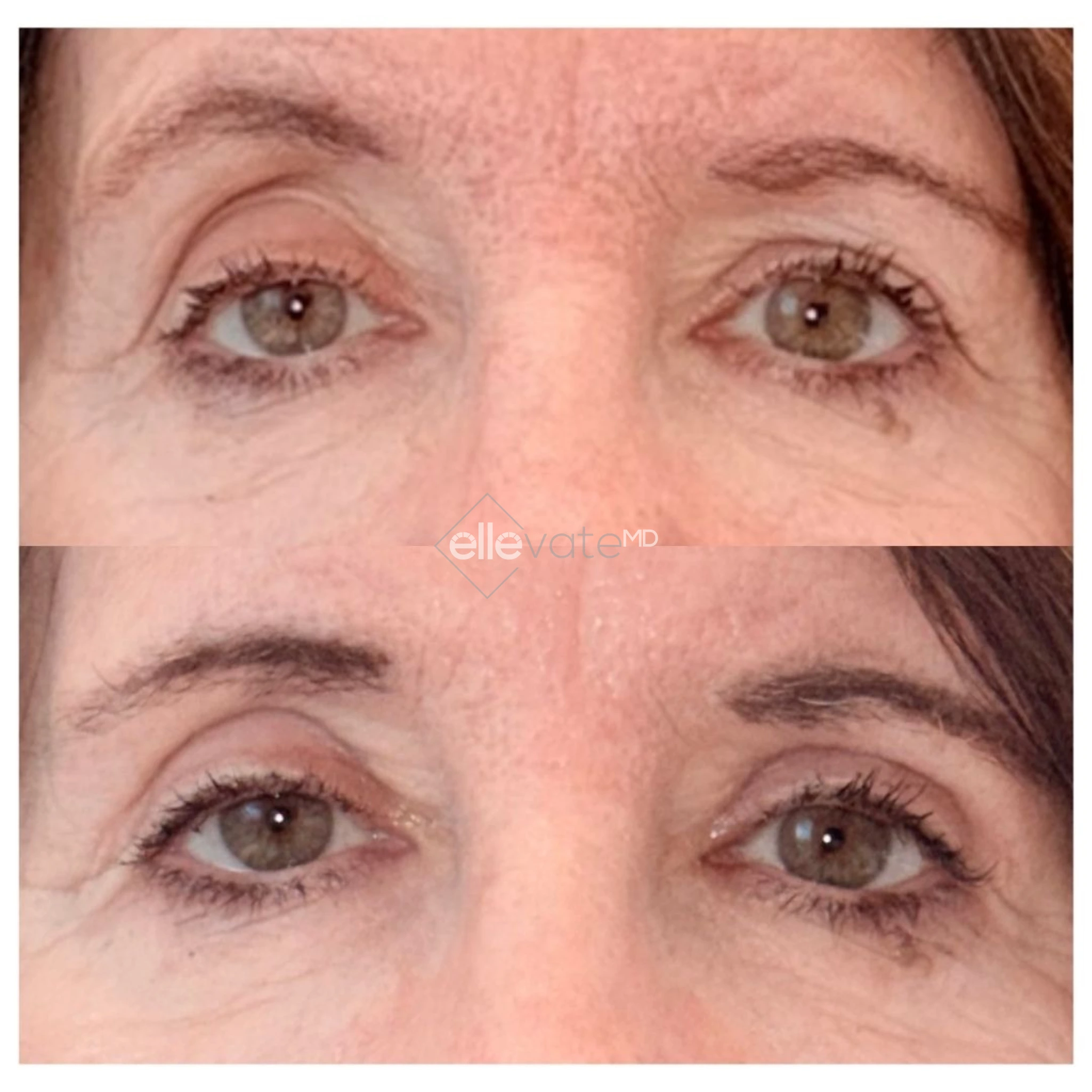 Upper Lid Lift for Asymmetry 18 before and after