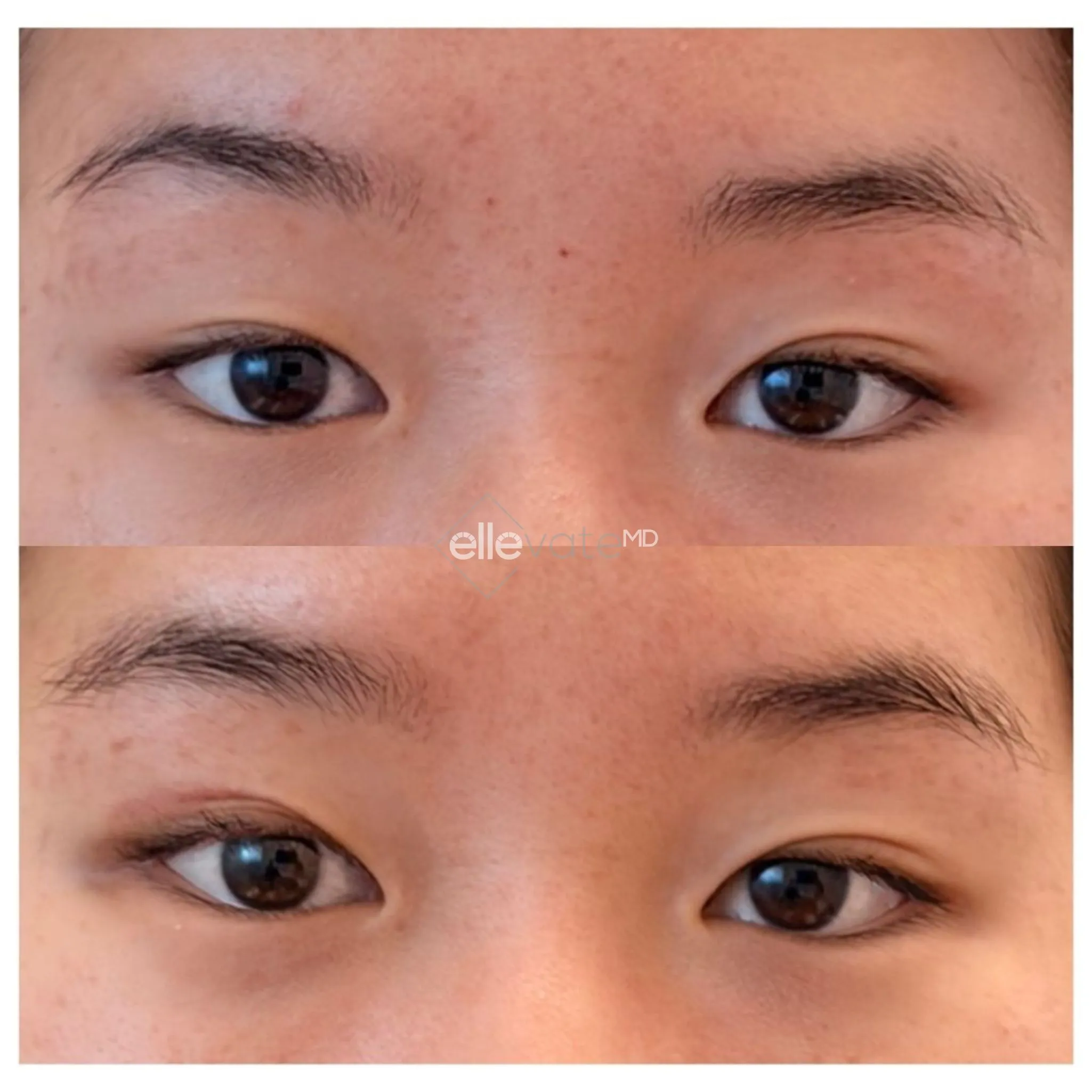 Upper Lid Lift for Asymmetry 19 before and after