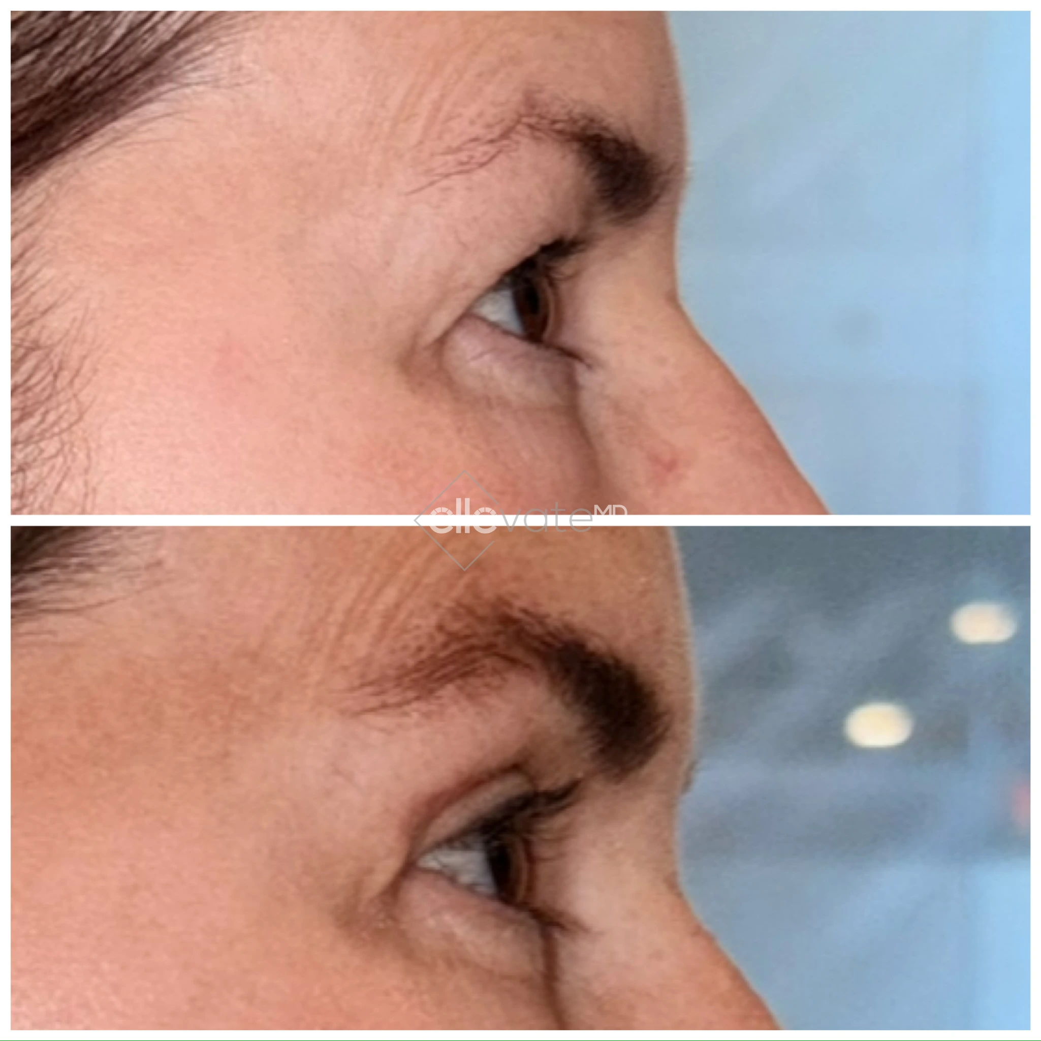 Upper Lid Lift Profile View 174 before and after