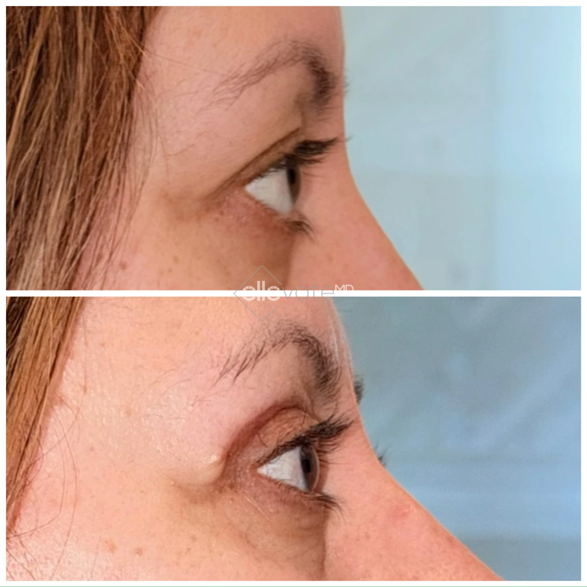Upper Lid Lift Profile View 175 before and after