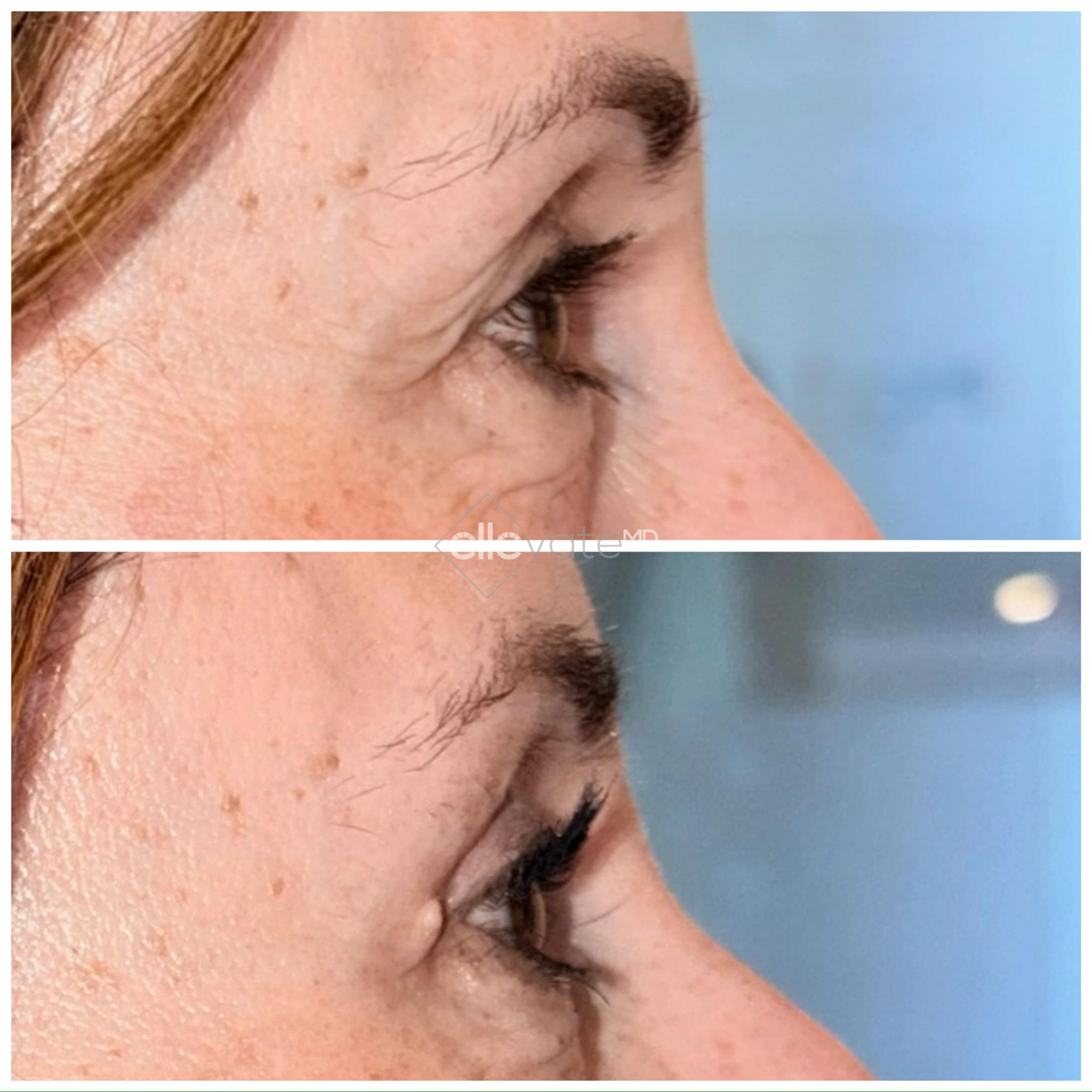 Upper Lid Lift Profile View 176 before and after
