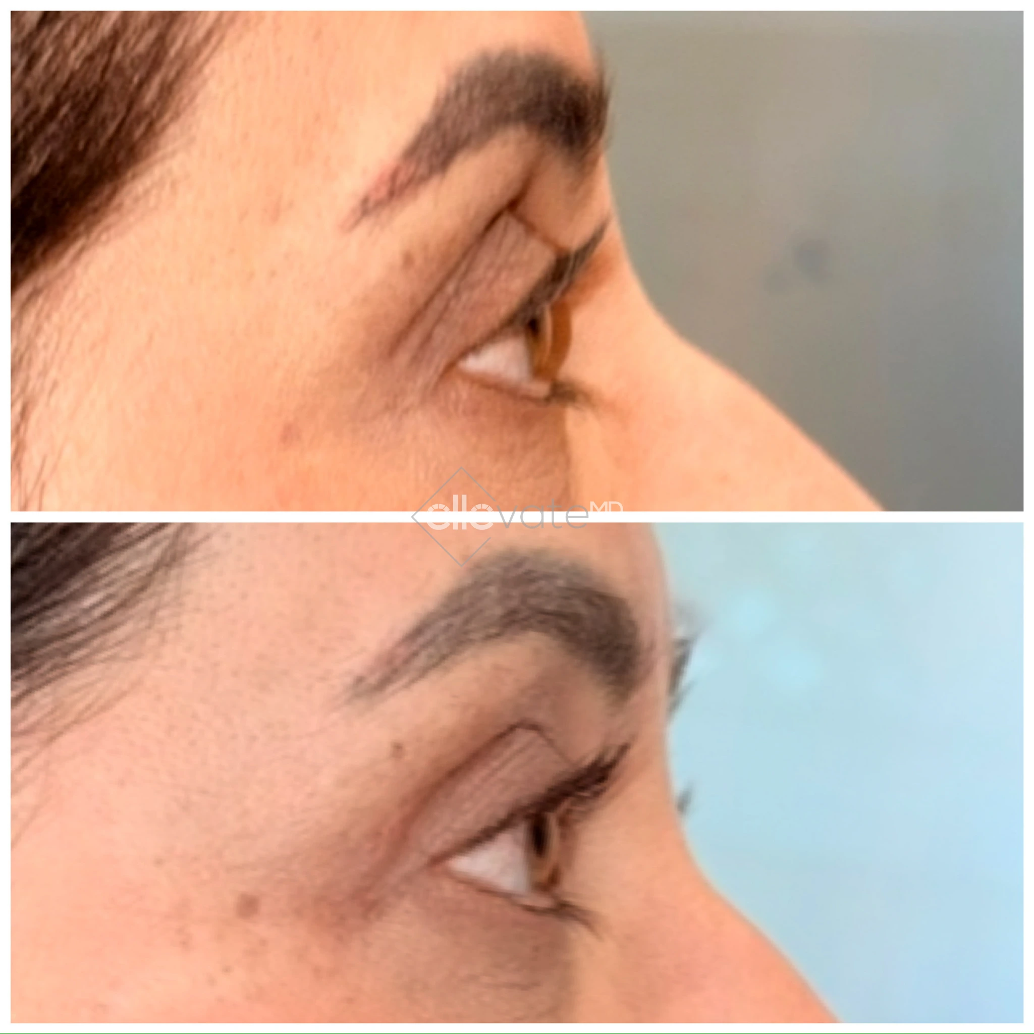 Upper Lid Lift Profile View 177 before and after
