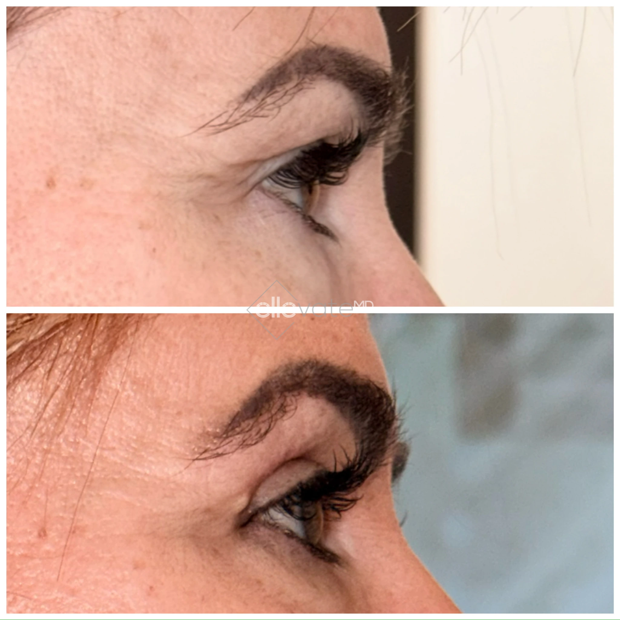 Upper Lid Lift Profile View 178 before and after