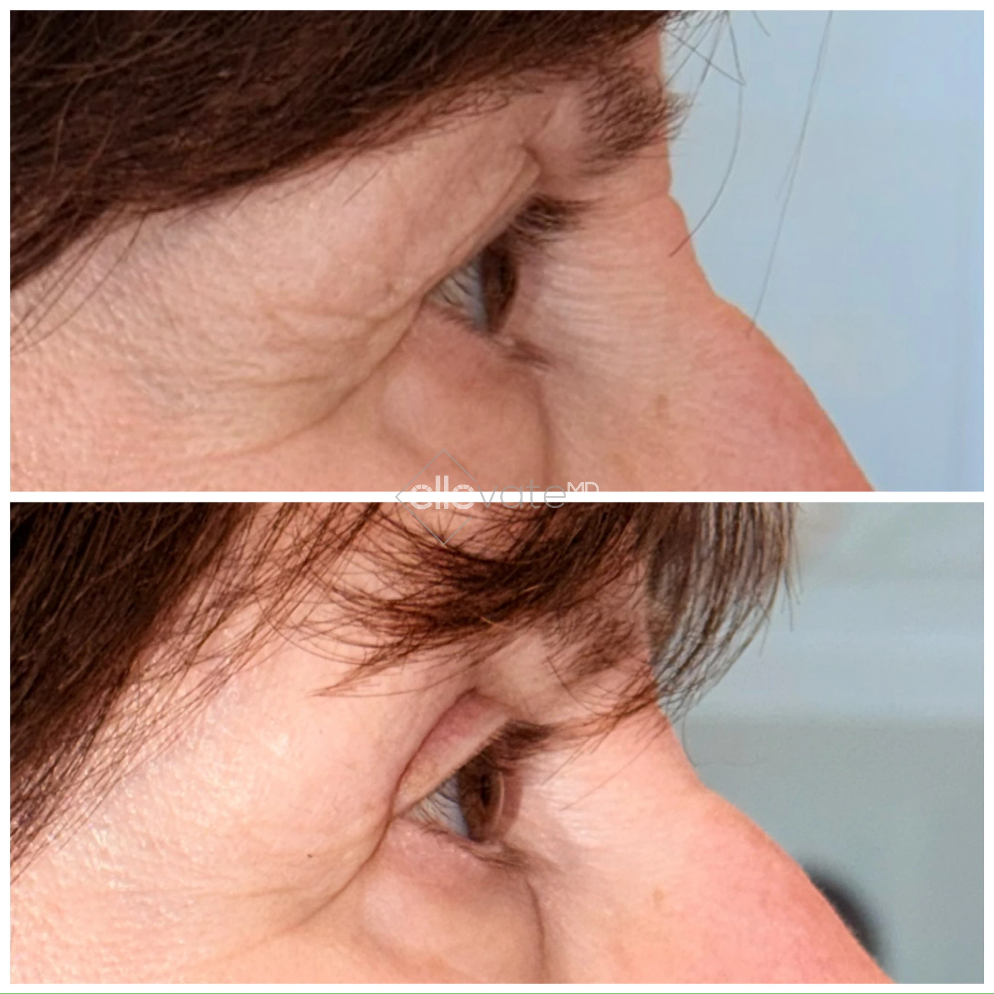 Upper Lid Lift Profile View 179 before and after