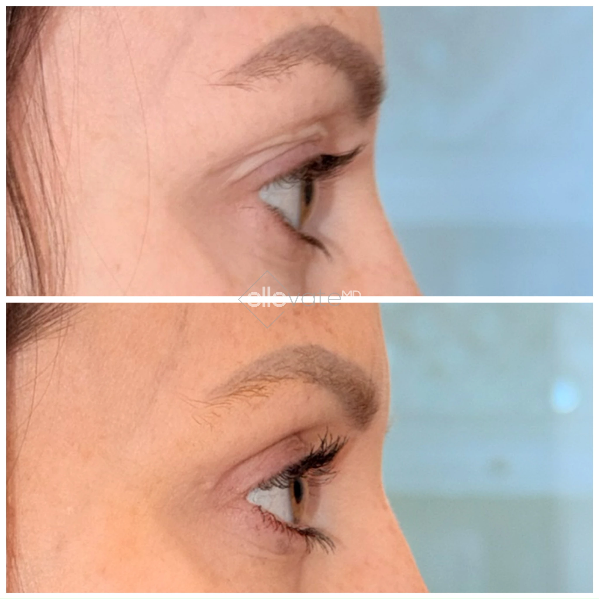 Upper Lid Lift Profile View 180 before and after