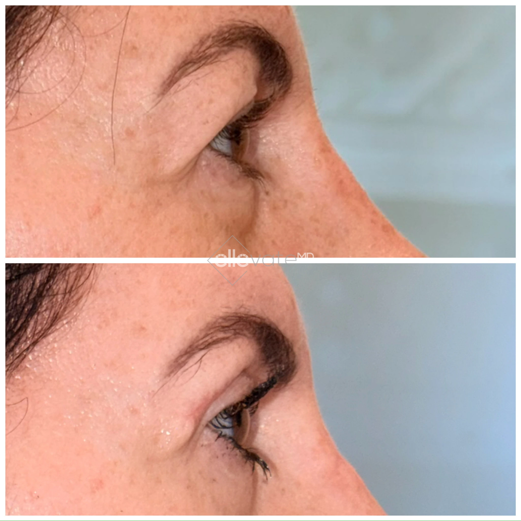 Upper Lid Lift Profile View 181 before and after