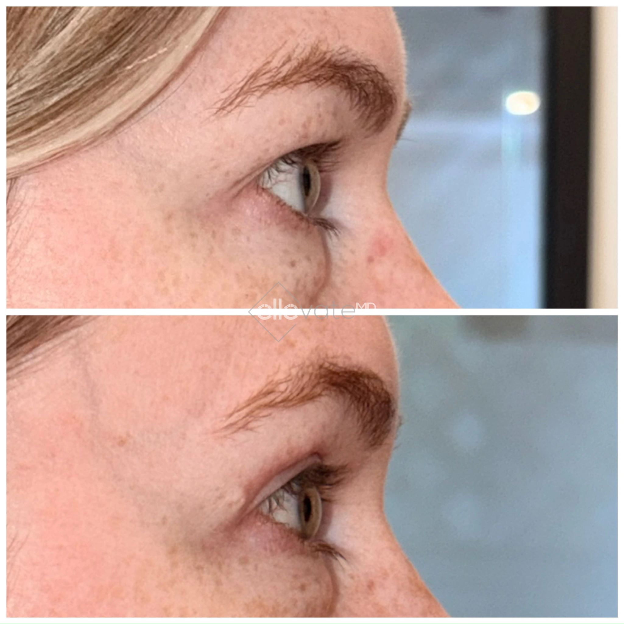 Upper Lid Lift Profile View 182 before and after