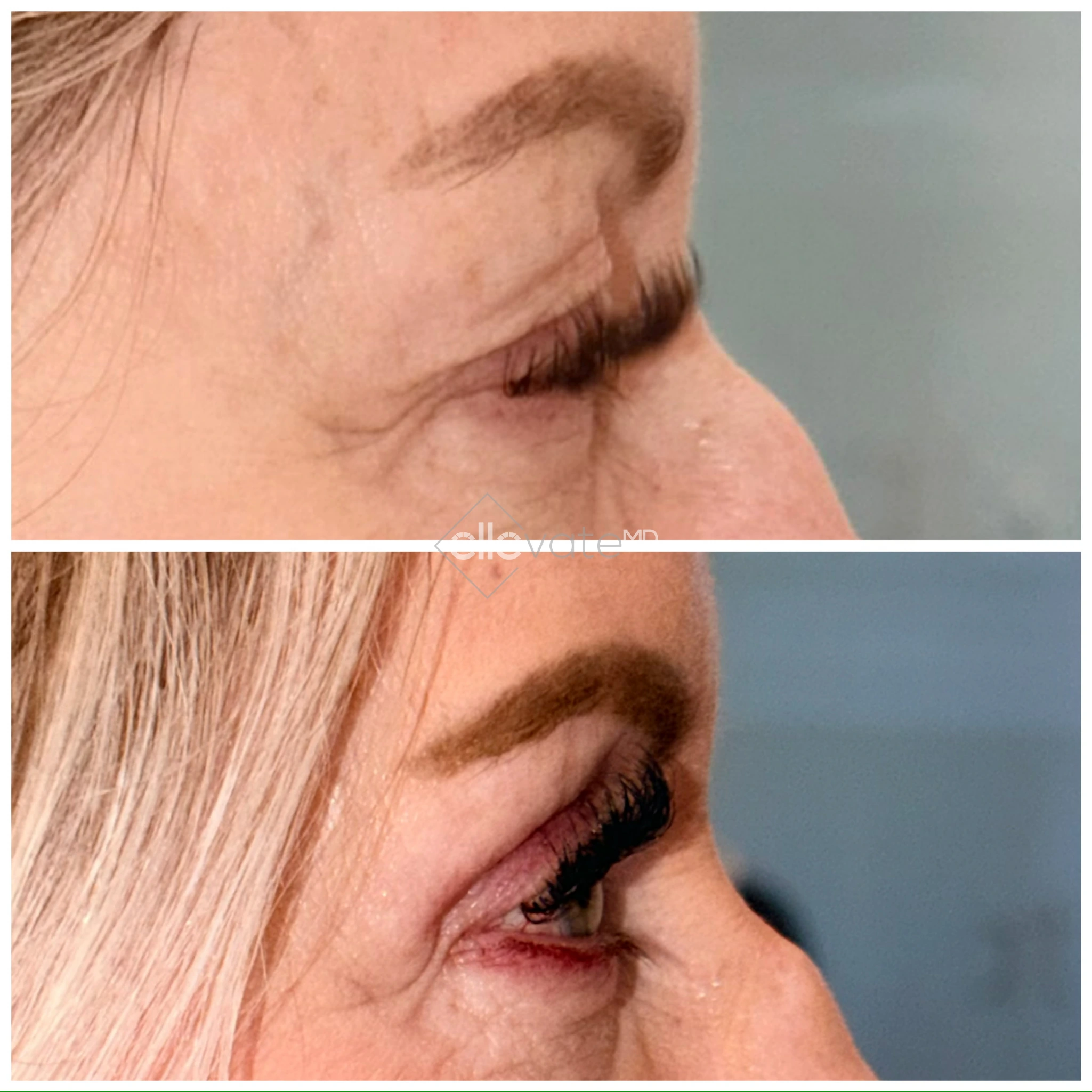 Upper Lid Lift Profile View 183 before and after