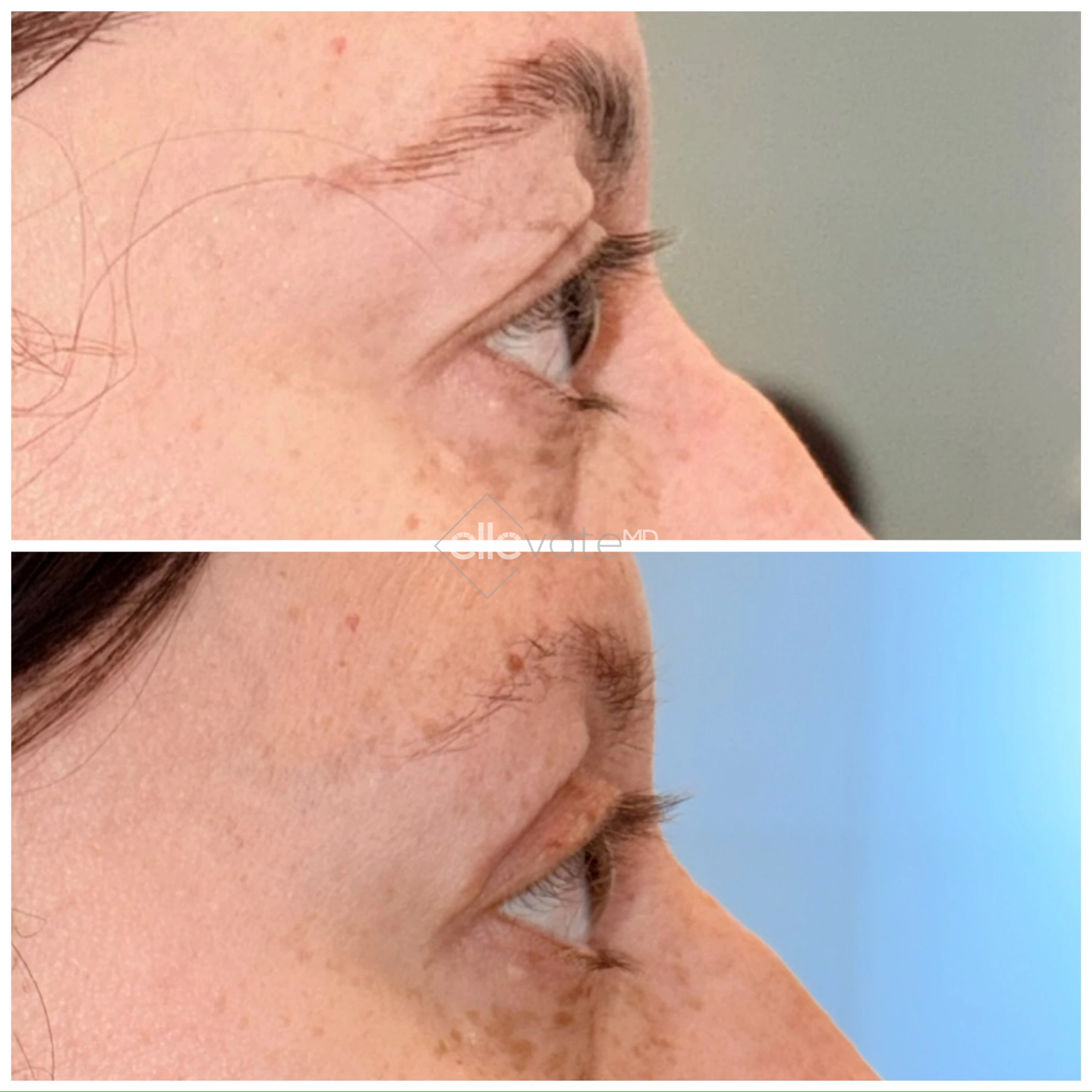 Upper Lid Lift Profile View 184 before and after