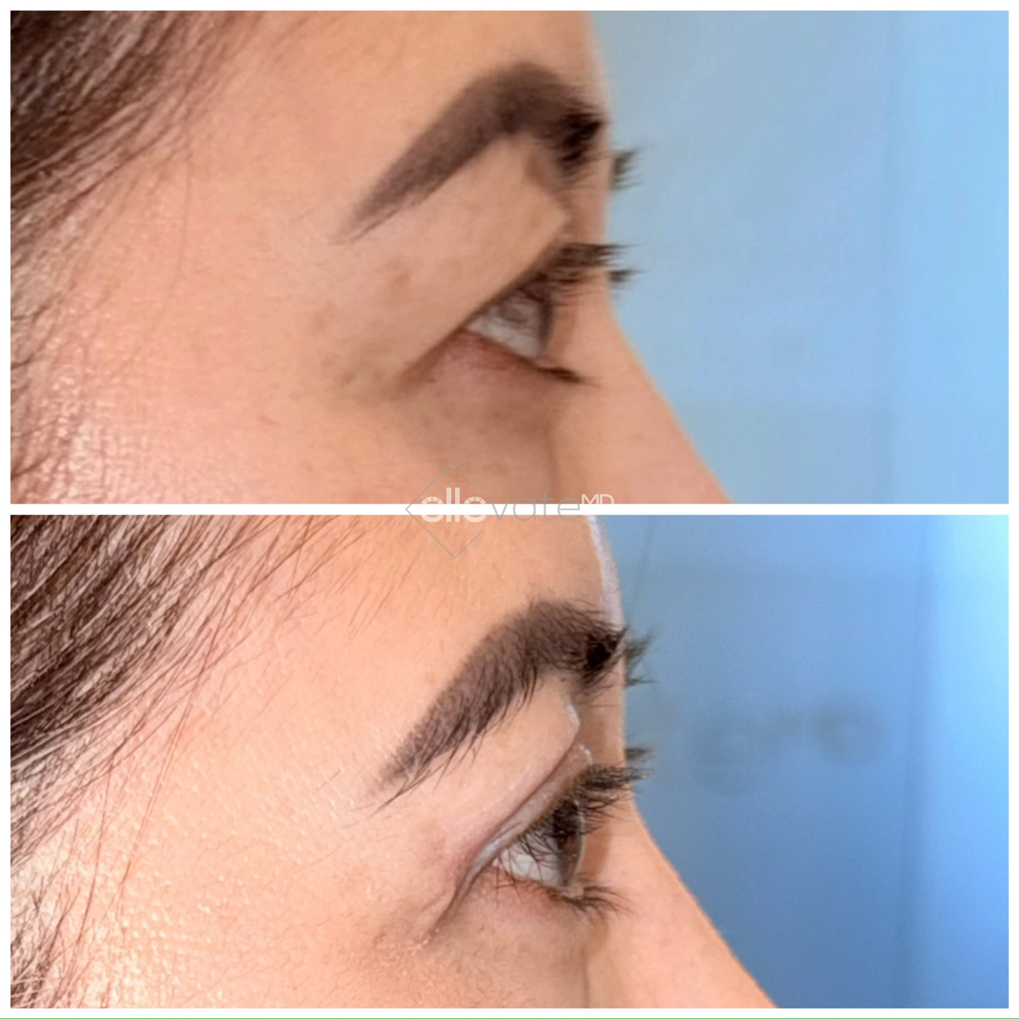 Upper Lid Lift Profile View 185 before and after