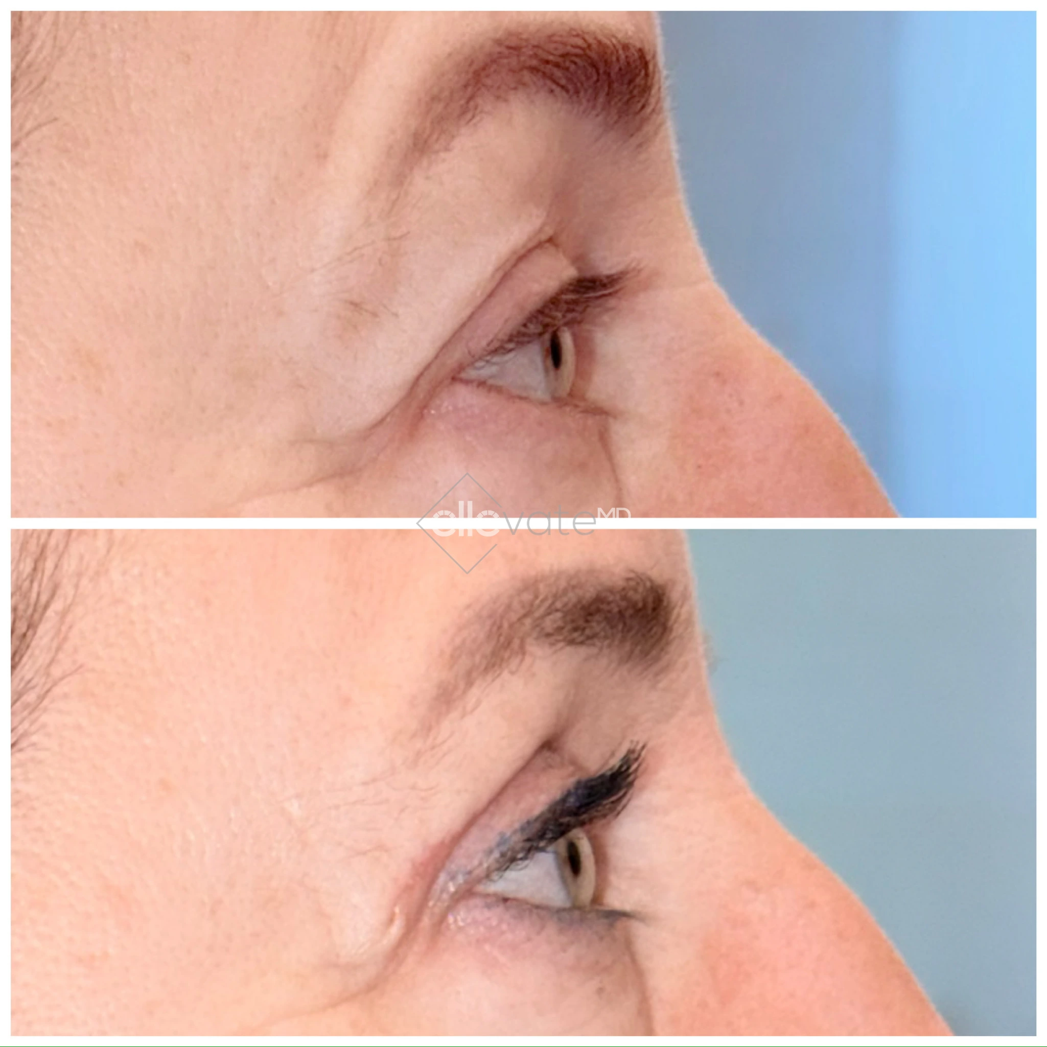 Upper Lid Lift Profile View 195 before and after