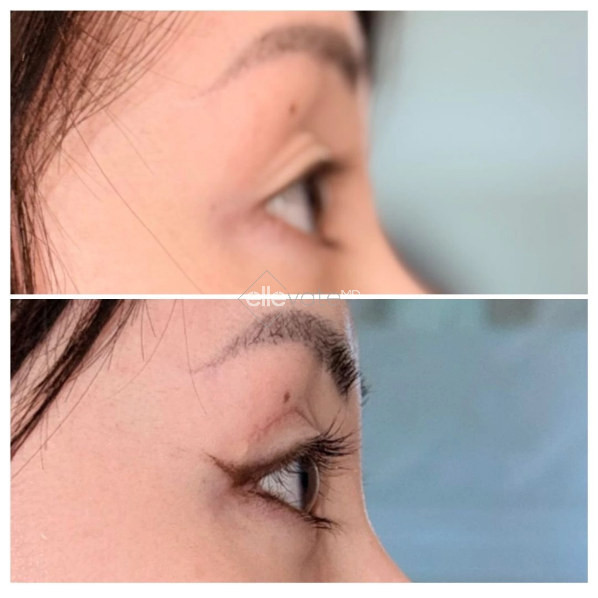 Upper Lid Lift Profile View 203 before and after