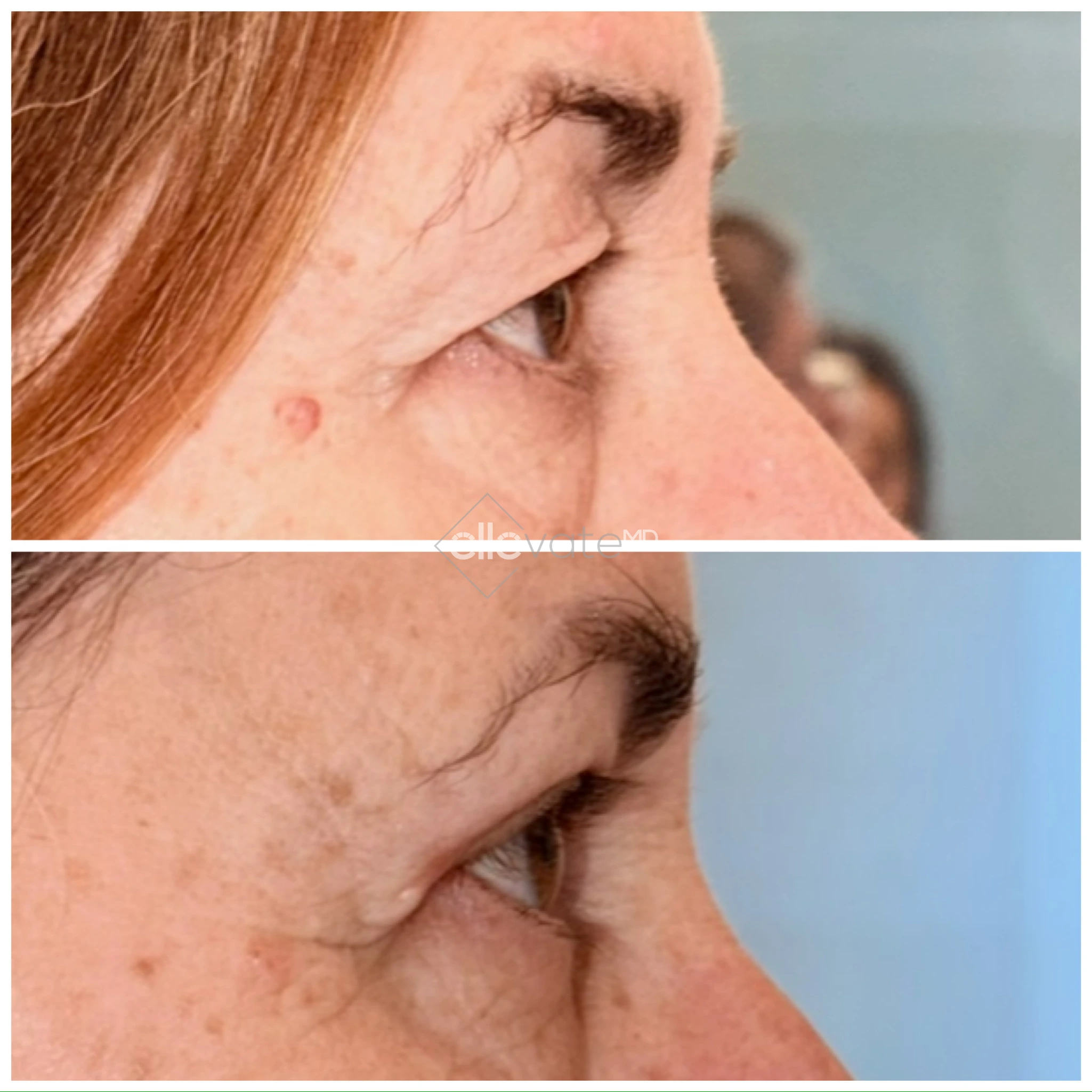 Upper Lid Lift Profile View 204 before and after