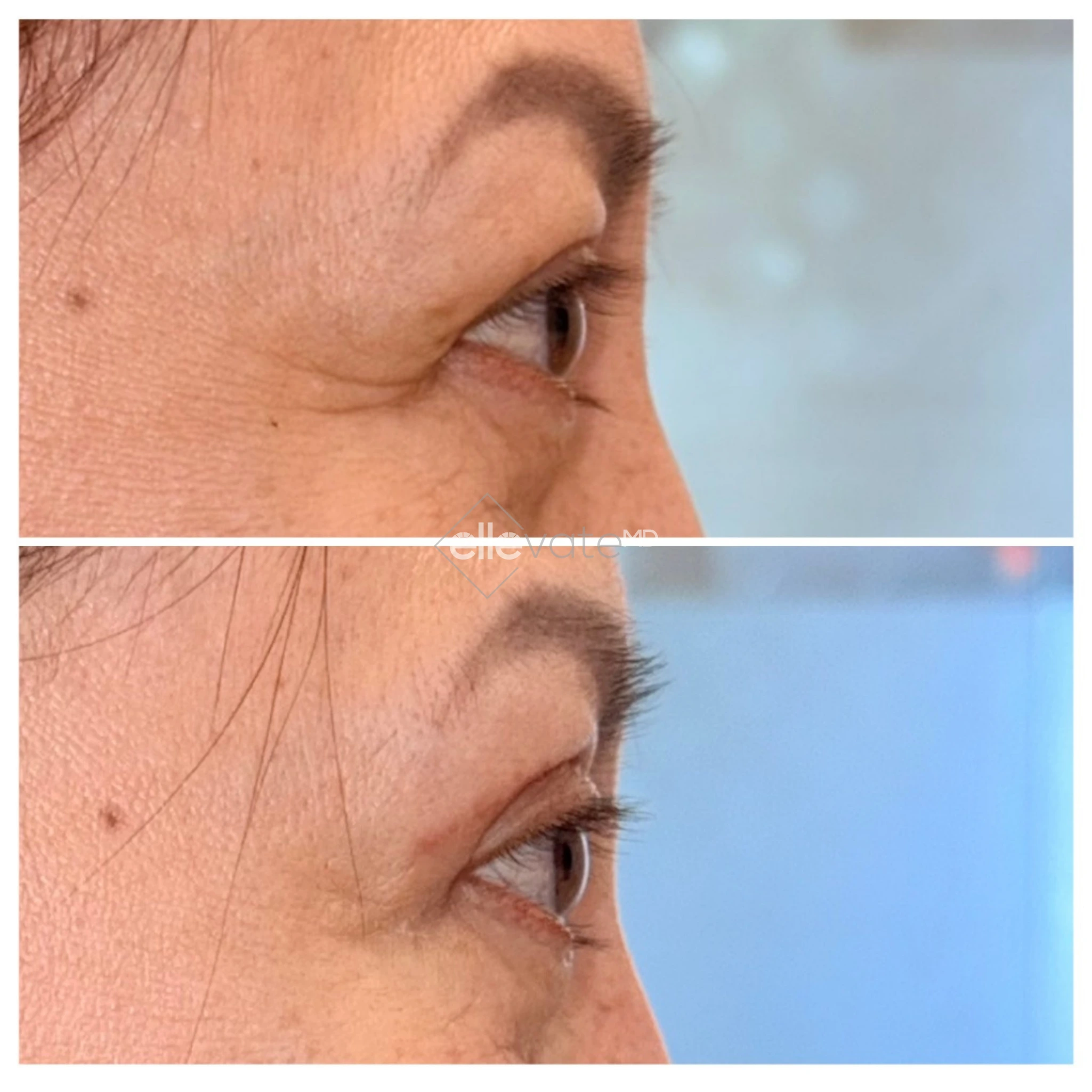 Upper Lid Lift Profile View 205 before and after