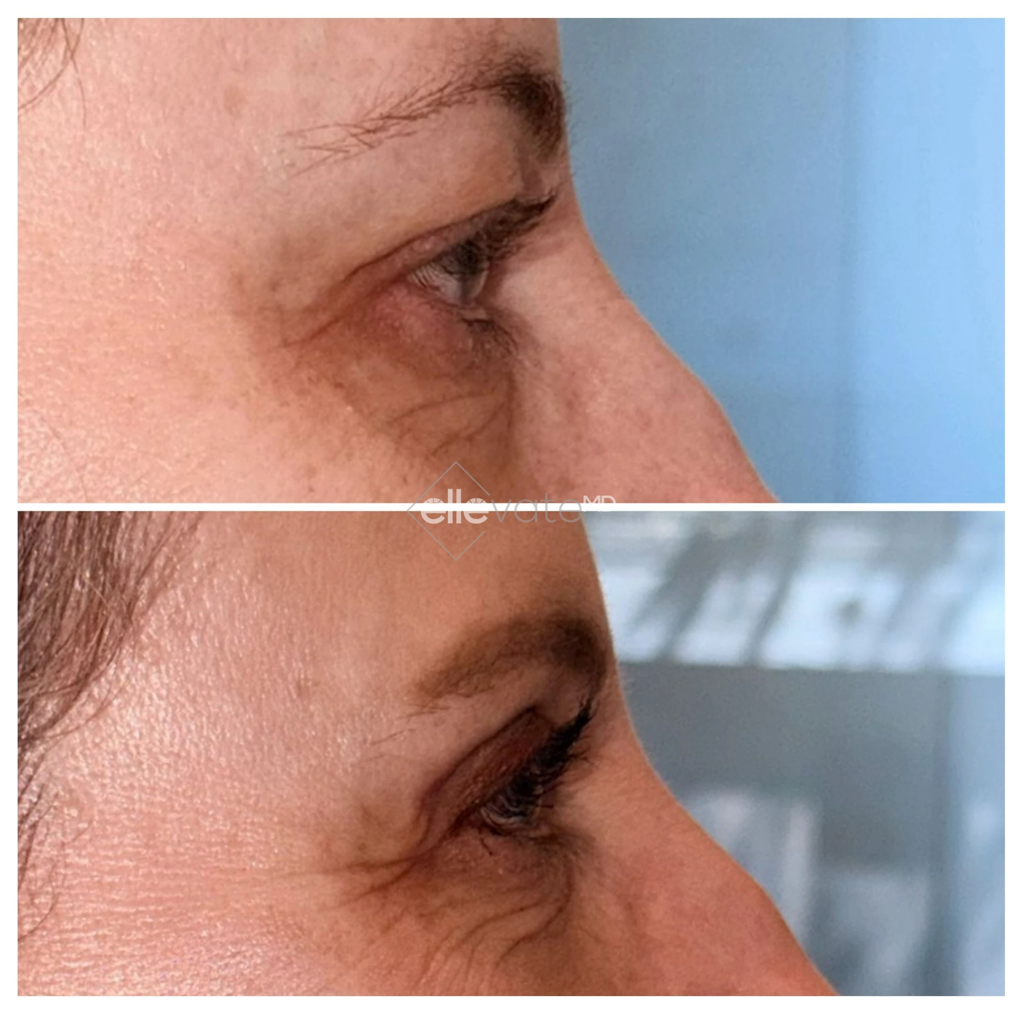 Upper Lid Lift Profile View 206 before and after