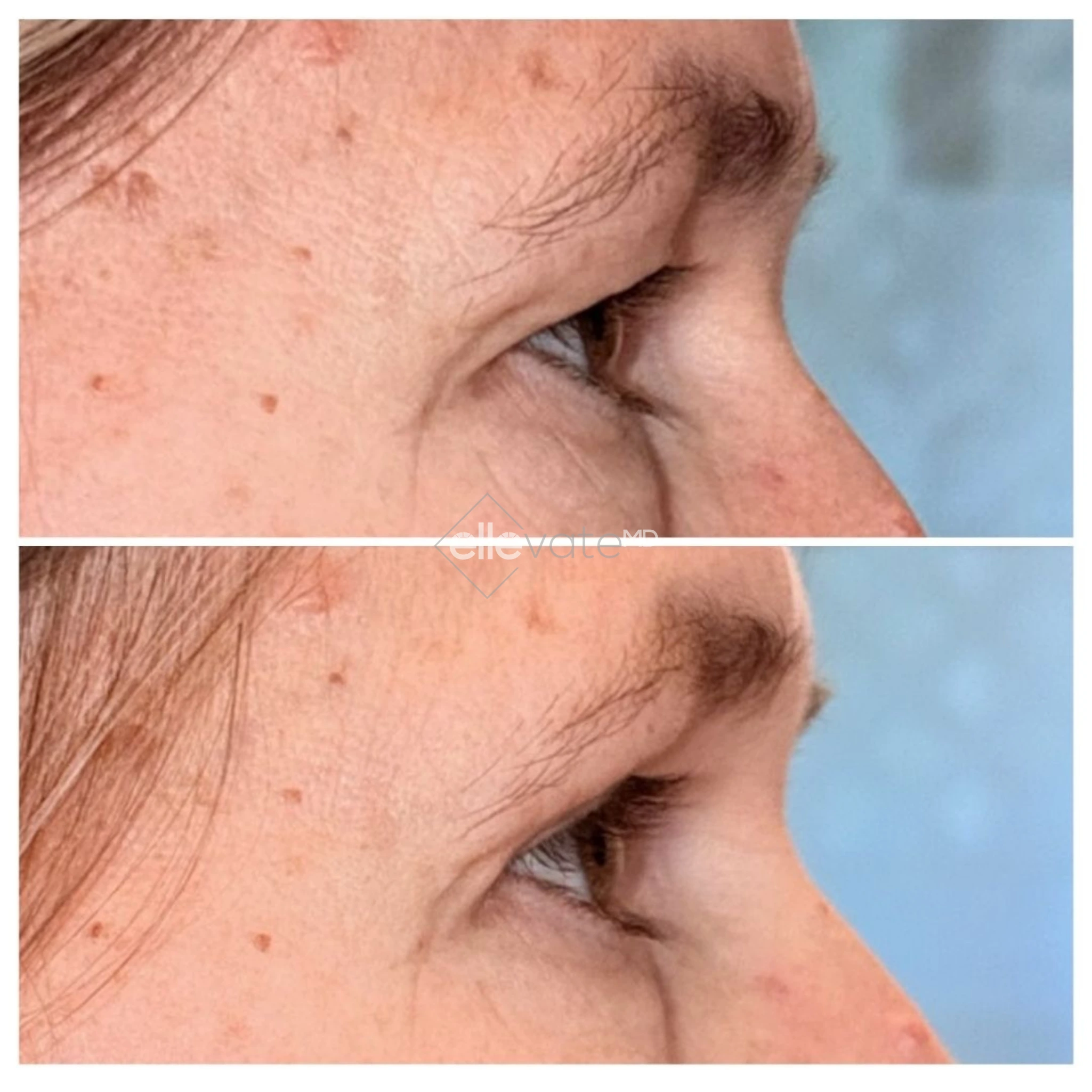 Upper Lid Lift Profile View 207 before and after
