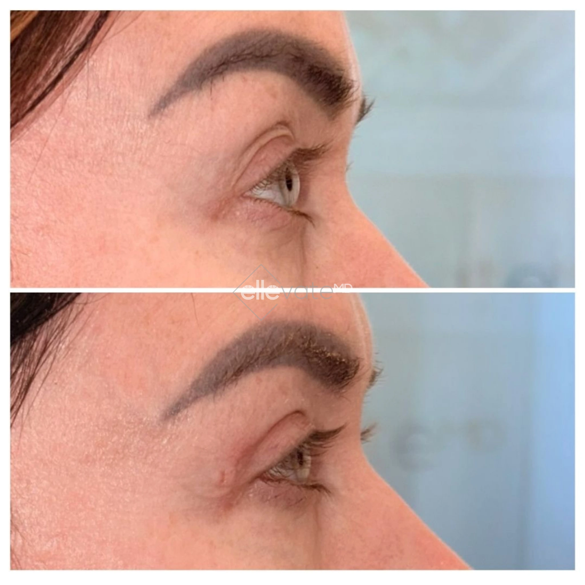 Upper Lid Lift Profile View 209 before and after