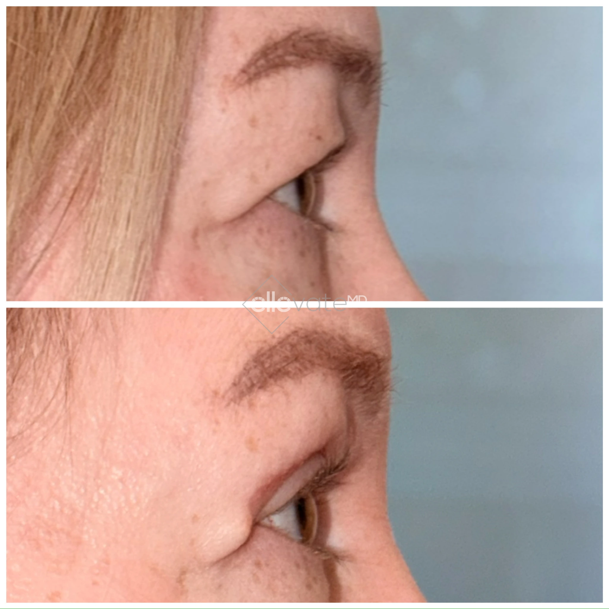 Upper Lid Lift Profile View 210 before and after