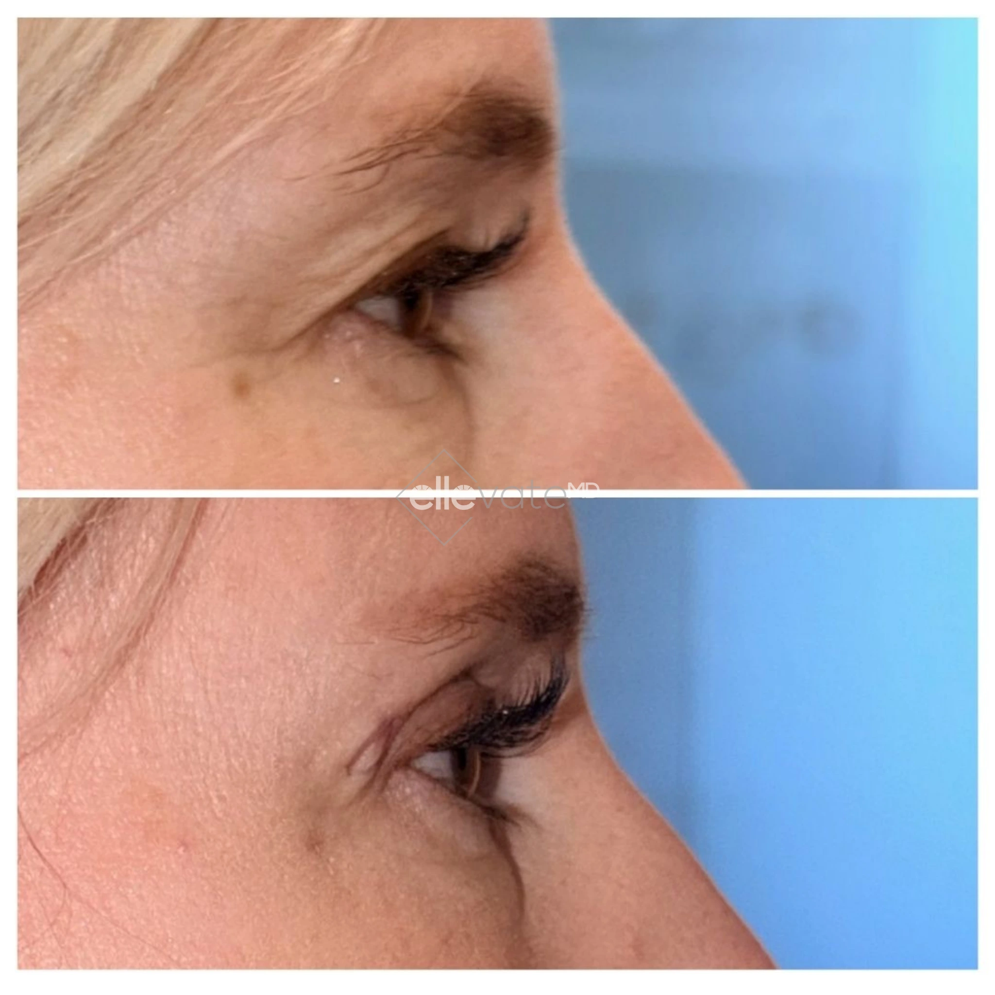 Upper Lid Lift Profile View 211 before and after