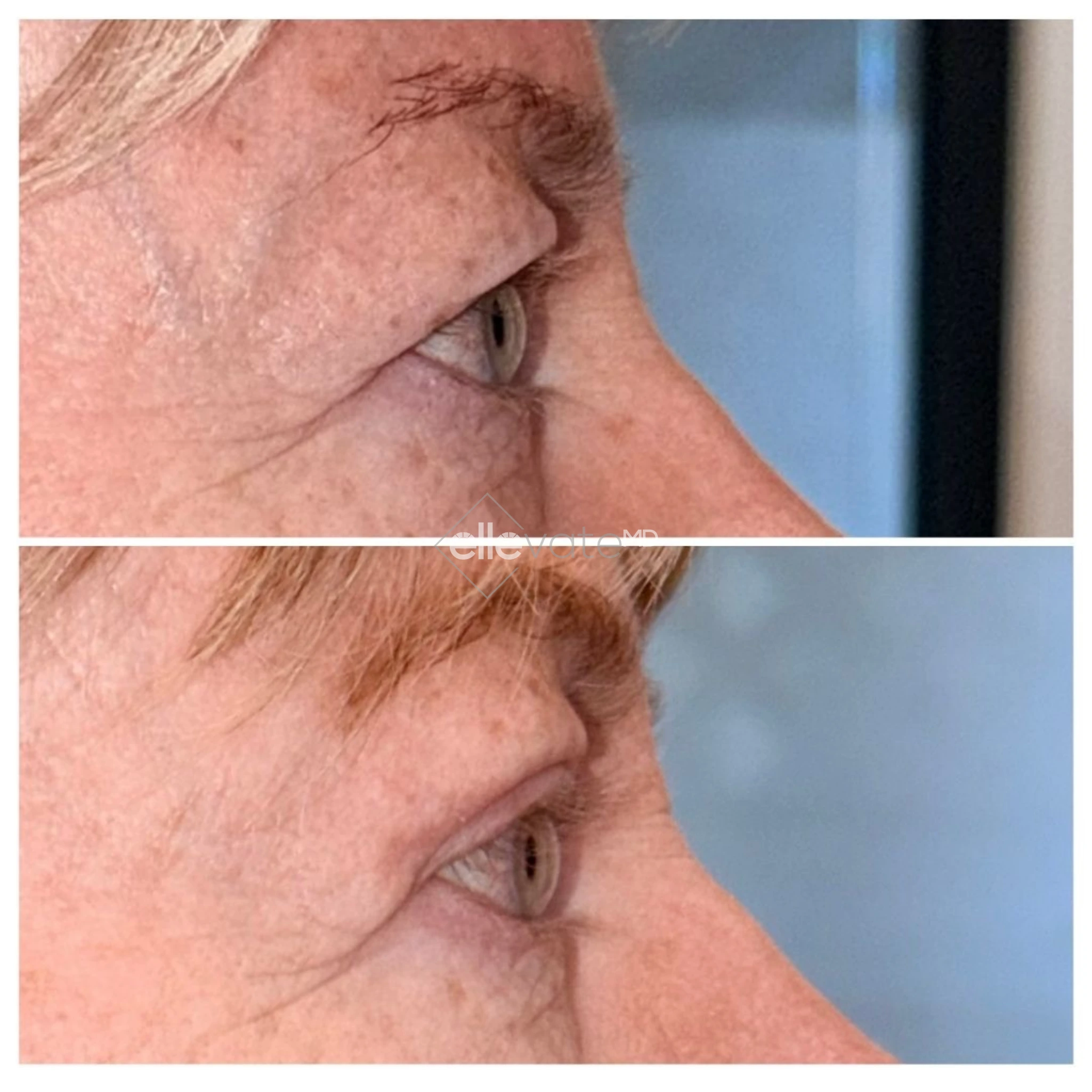 Upper Lid Lift Profile View 212 before and after