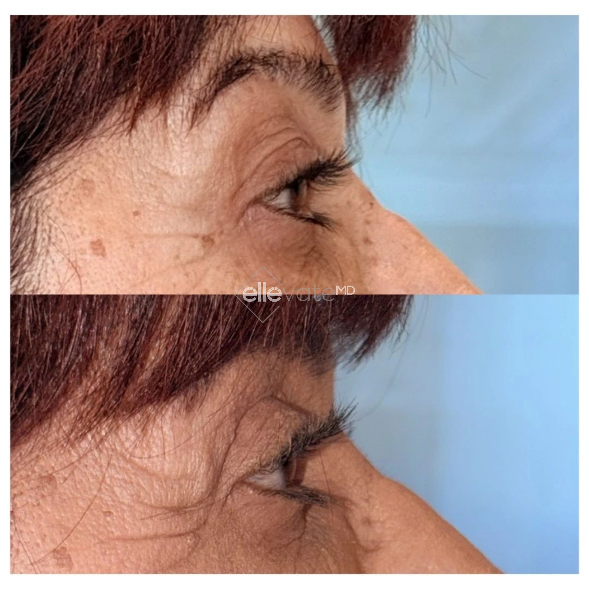 Upper Lid Lift Profile View 213 before and after