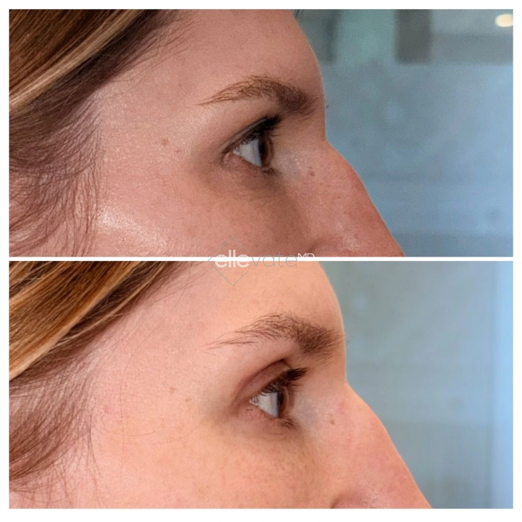 Upper Lid Lift Profile View 214 before and after