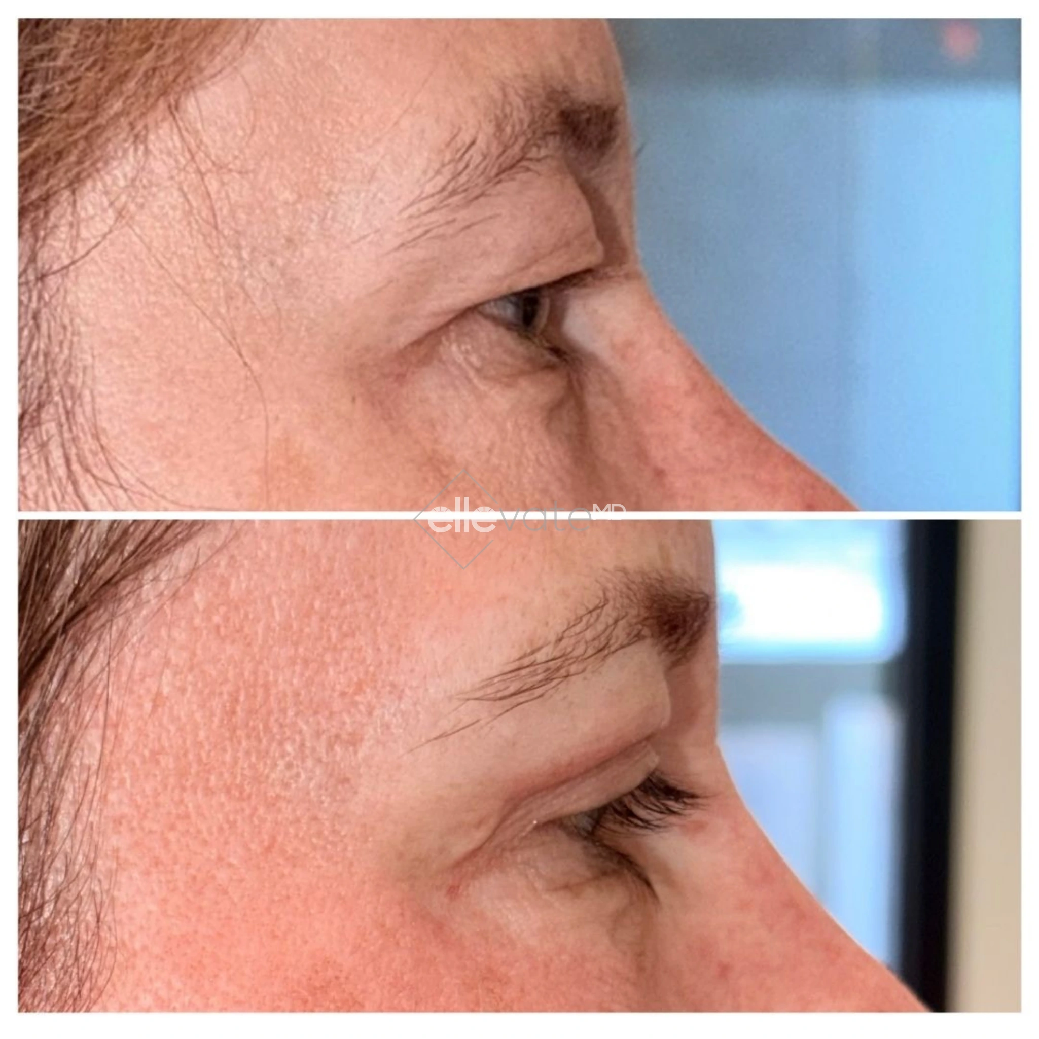 Upper Lid Lift Profile View 216 before and after