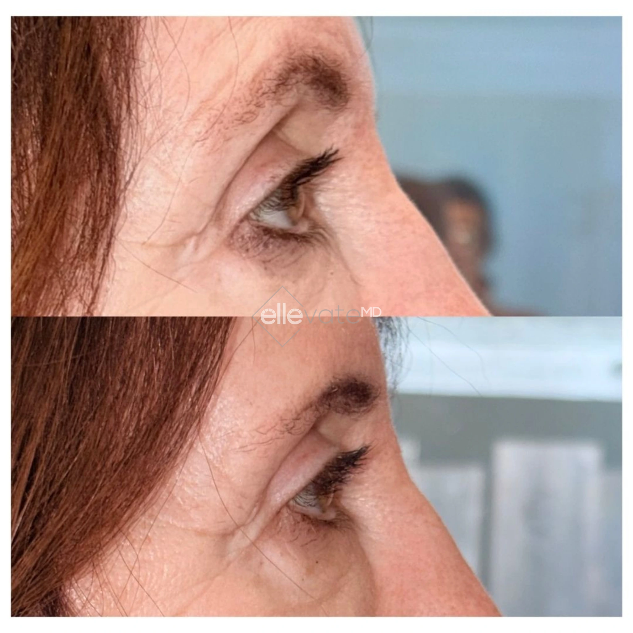 Upper Lid Lift Profile View 217 before and after