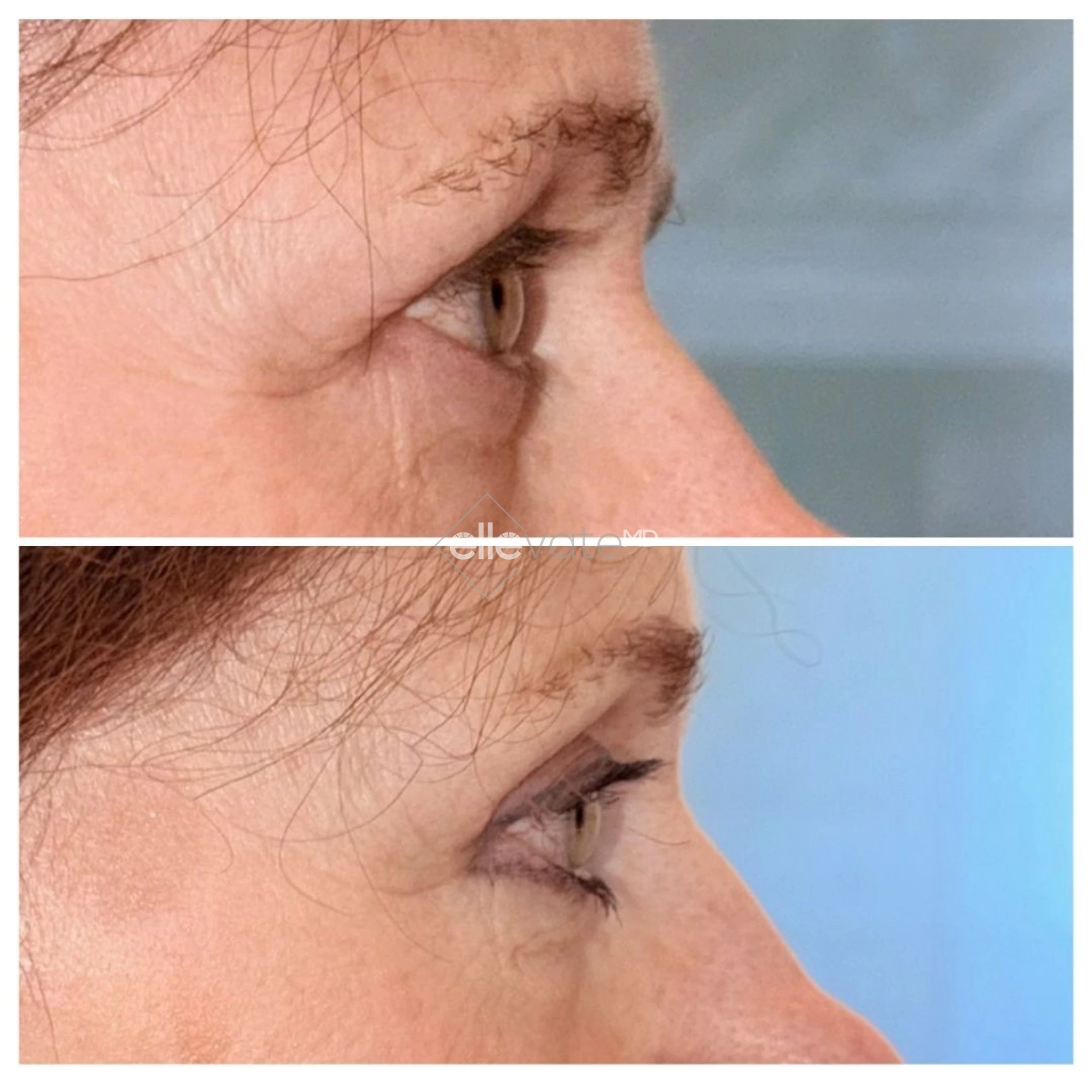 Upper Lid Lift Profile View 218 before and after
