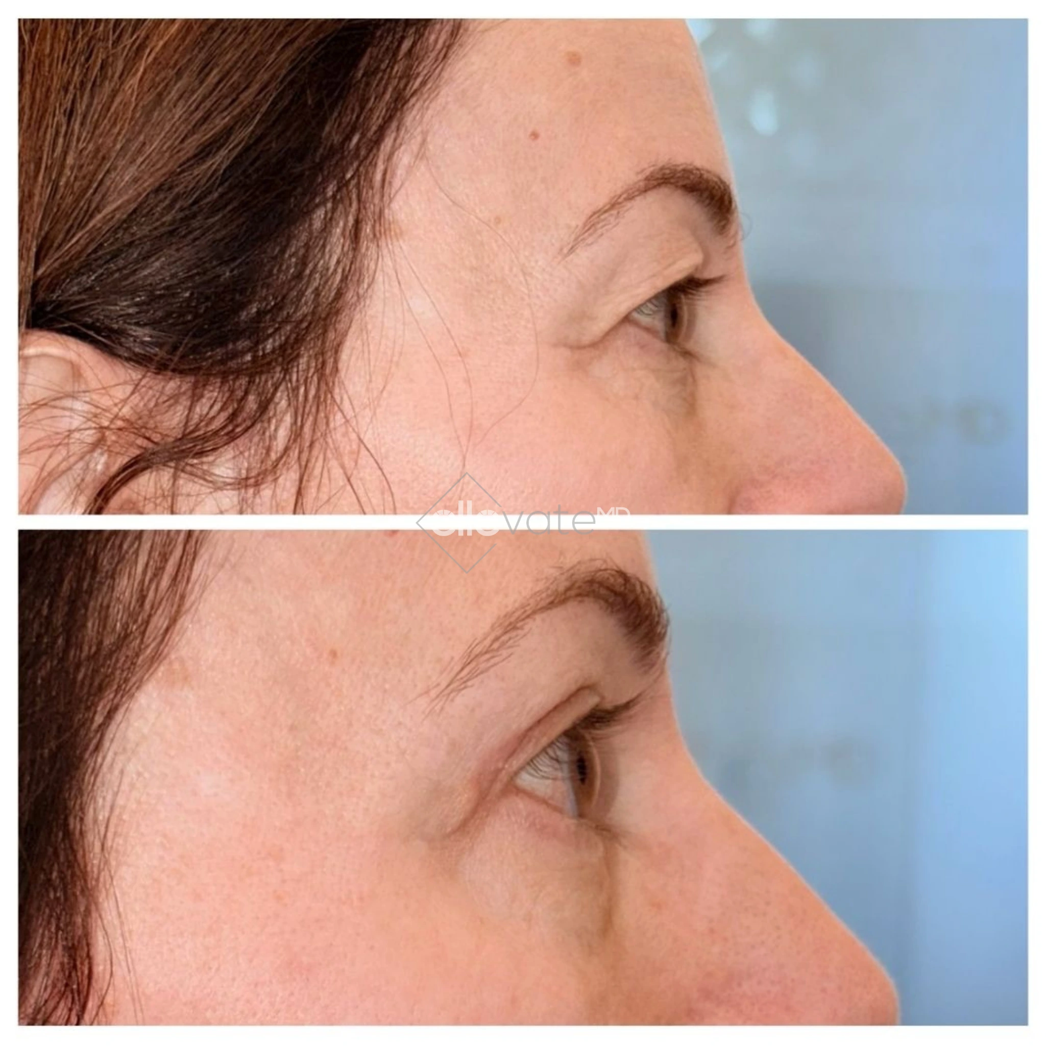 Upper Lid Lift Profile View 219 before and after