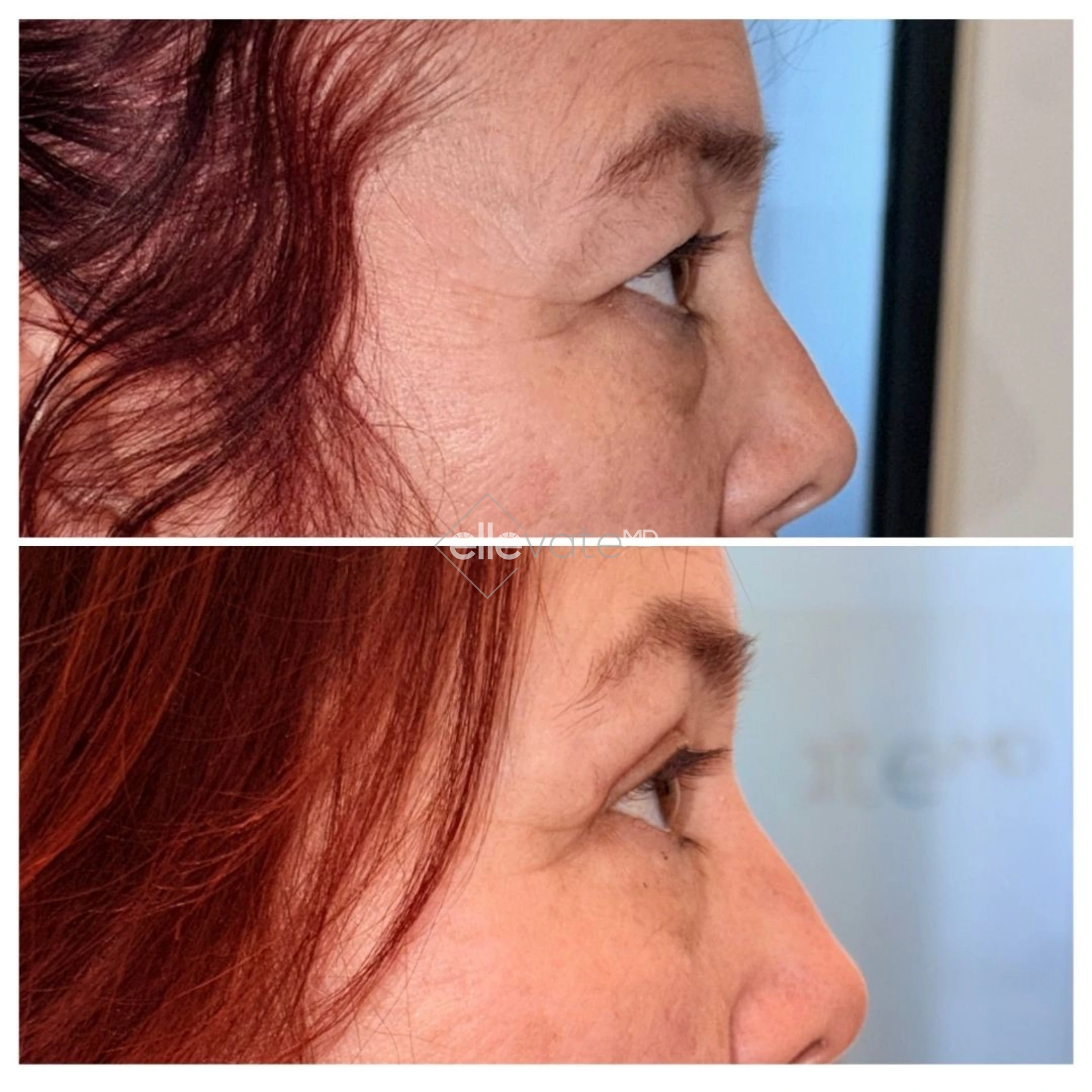Upper Lid Lift Profile View 220 before and after