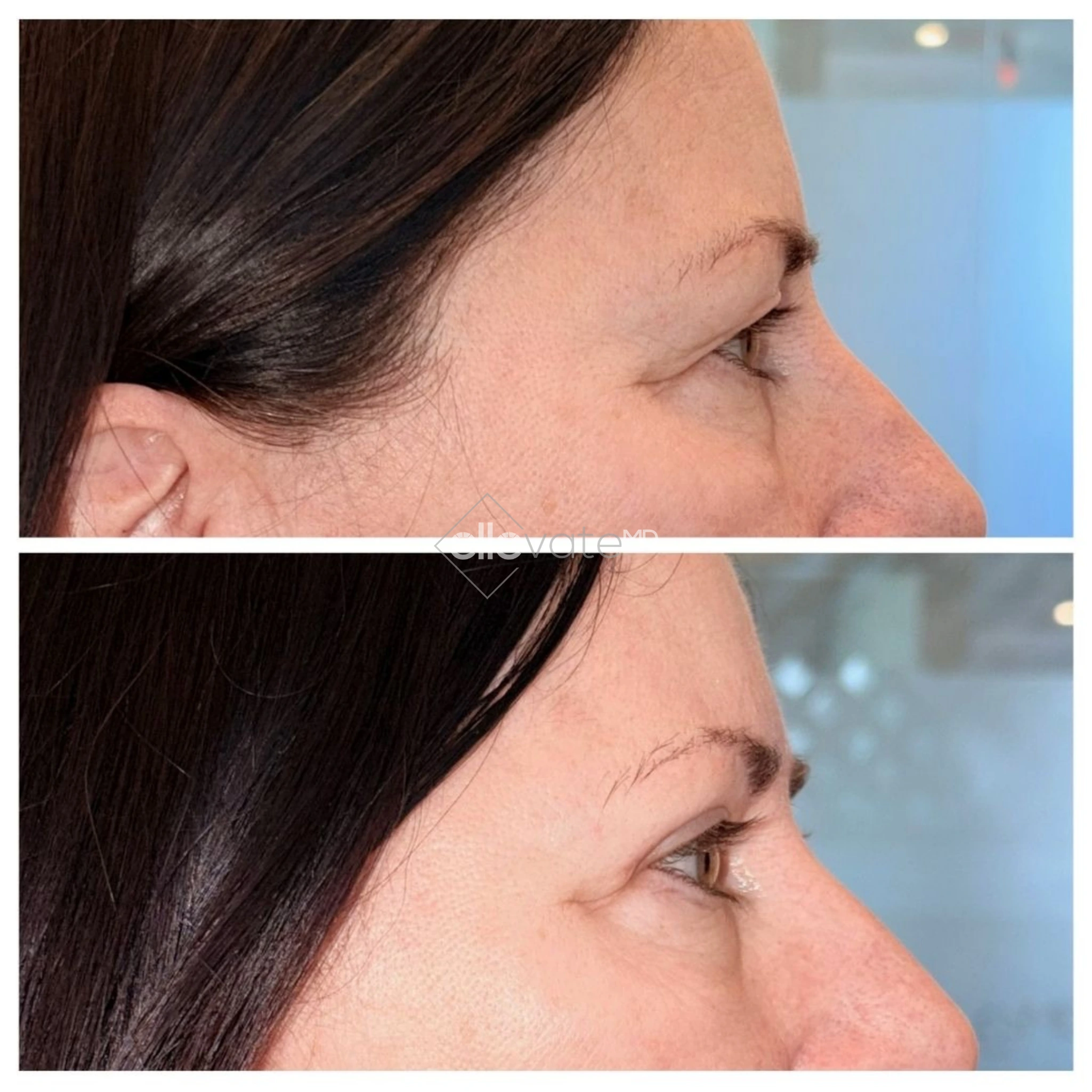 Upper Lid Lift Profile View 221 before and after