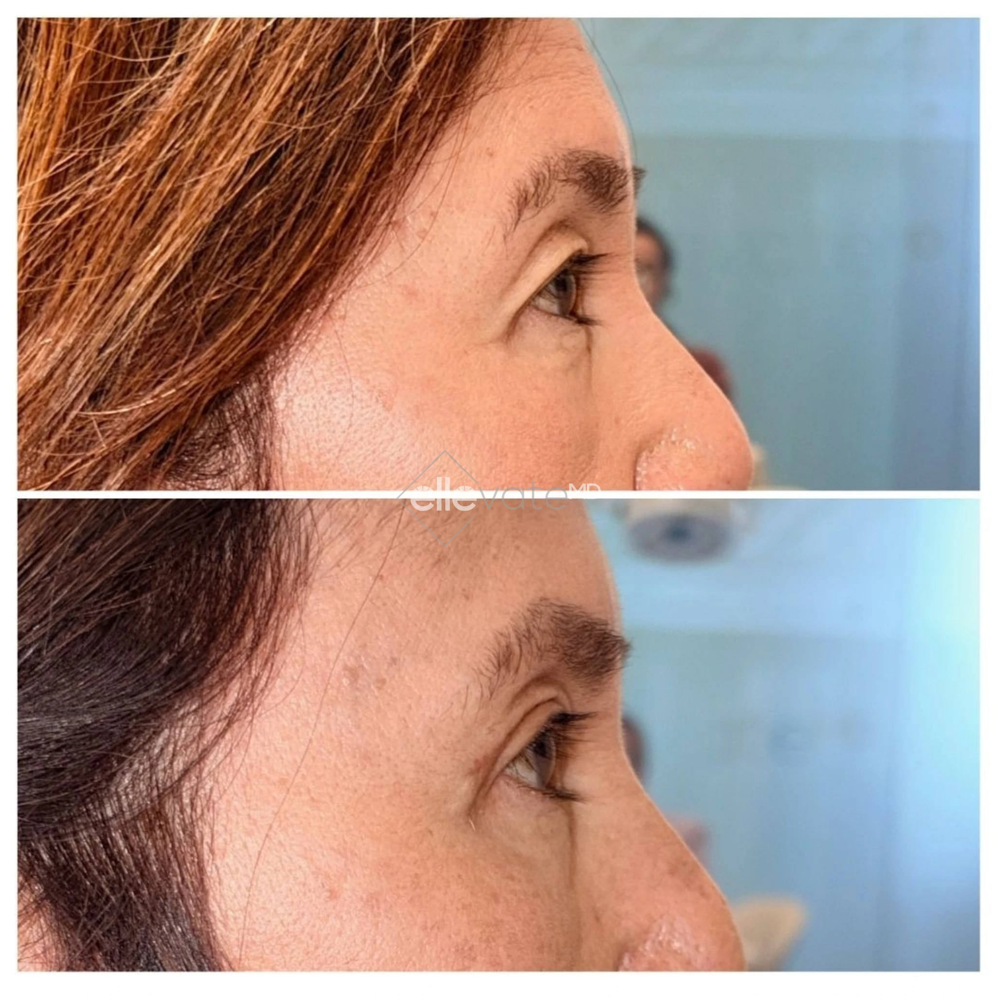 Upper Lid Lift Profile View 222 before and after