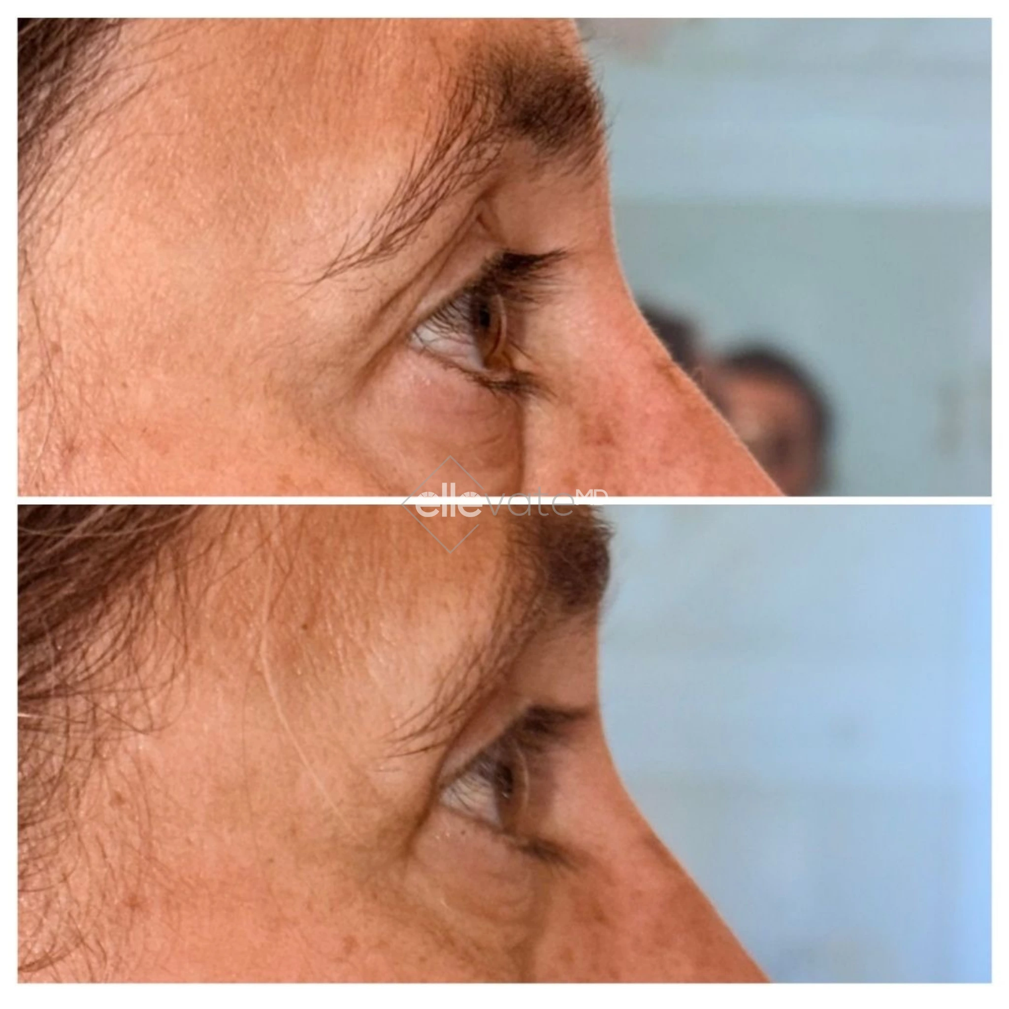 Upper Lid Lift Profile View 223 before and after