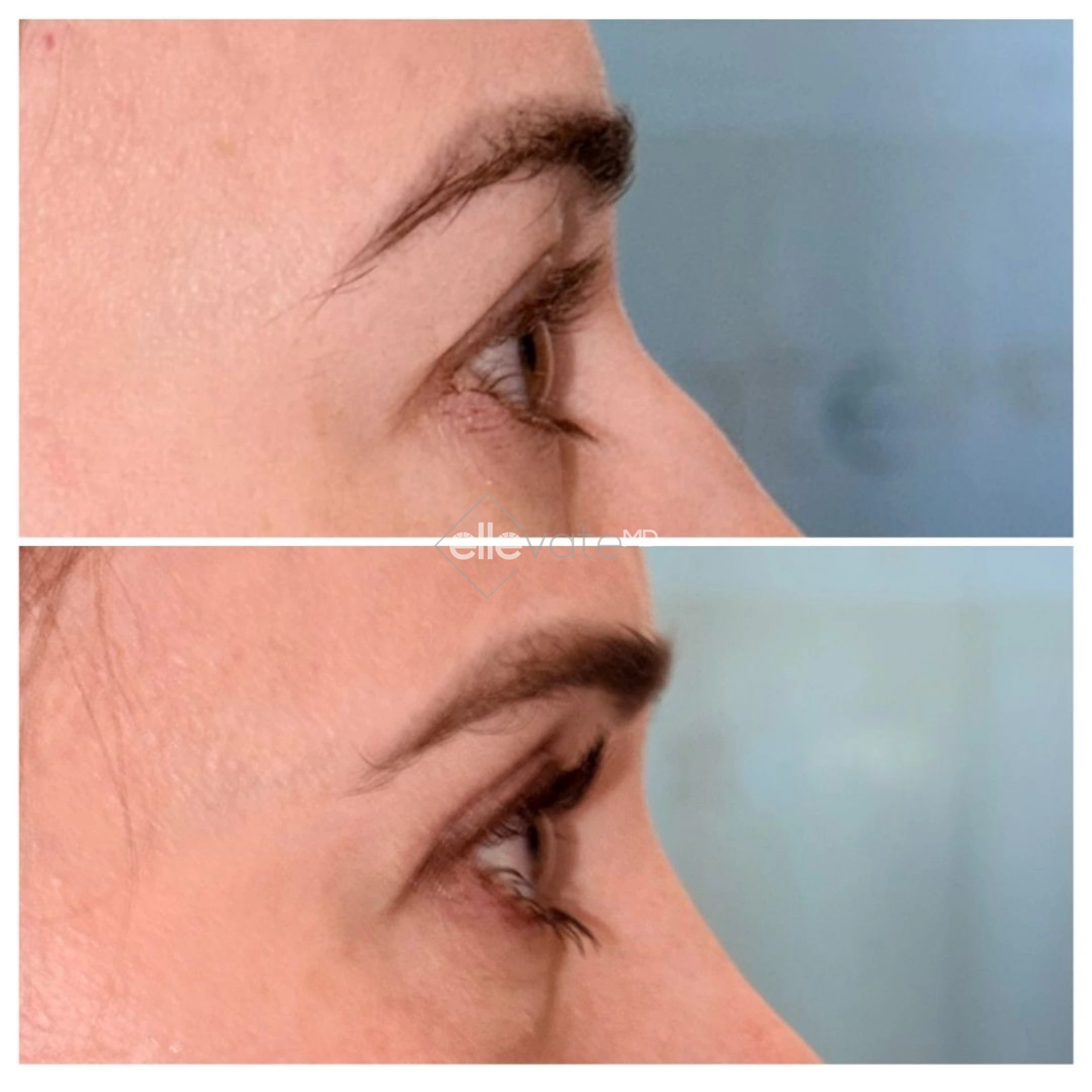 Upper Lid Lift Profile View 224 before and after