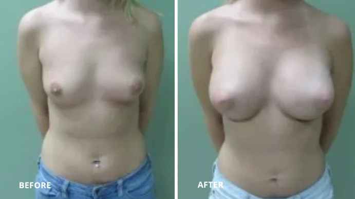 Breast augmentation before and after comparison, frontal view