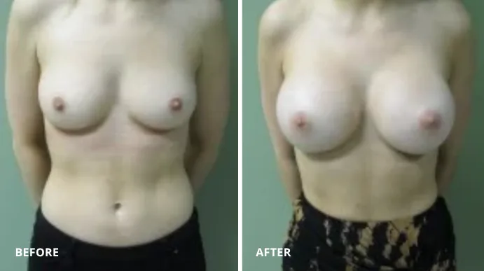 Breast augmentation before and after comparison, frontal view